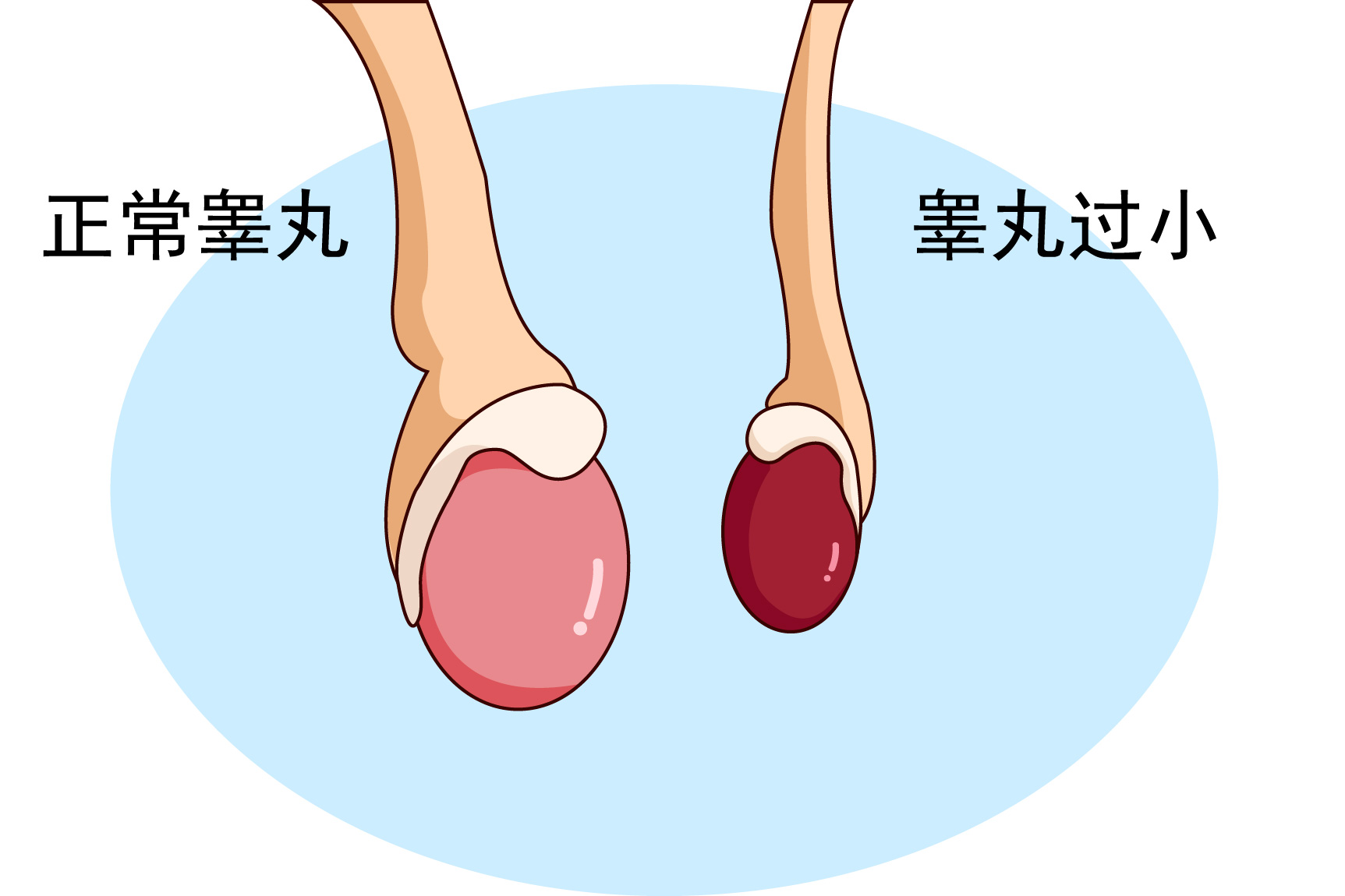 睾丸过小图片