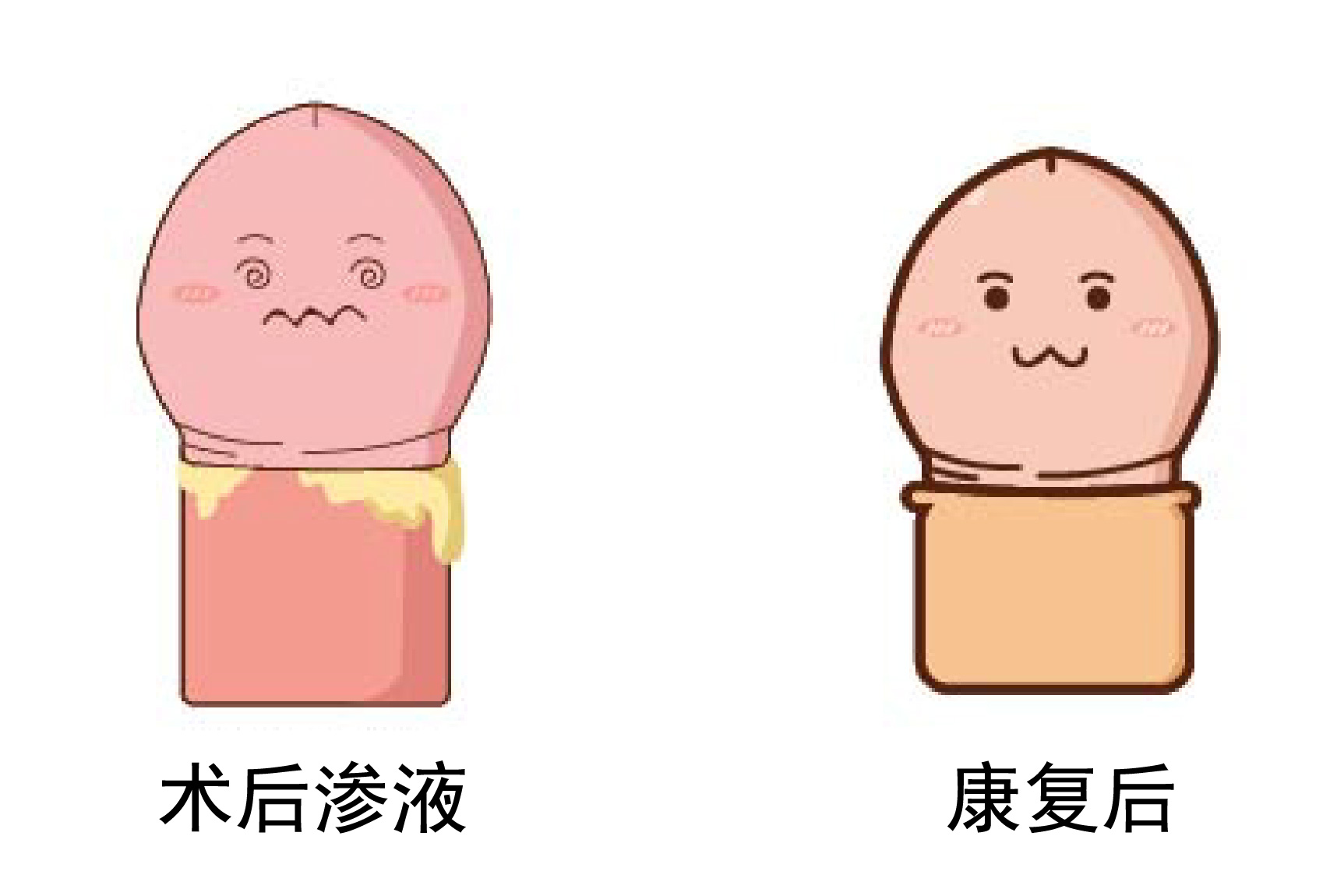 包皮术后渗液图片