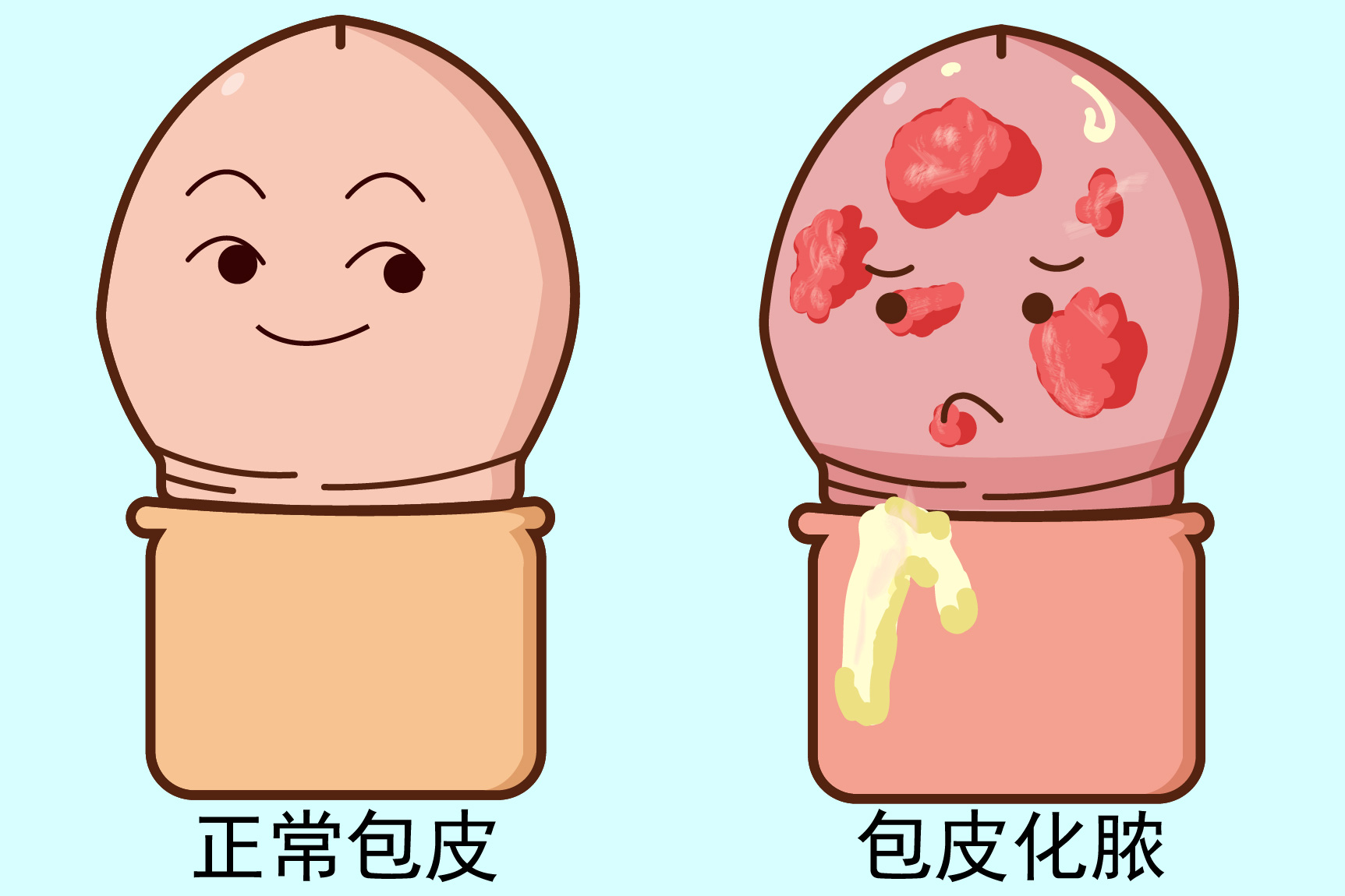包皮化脓图