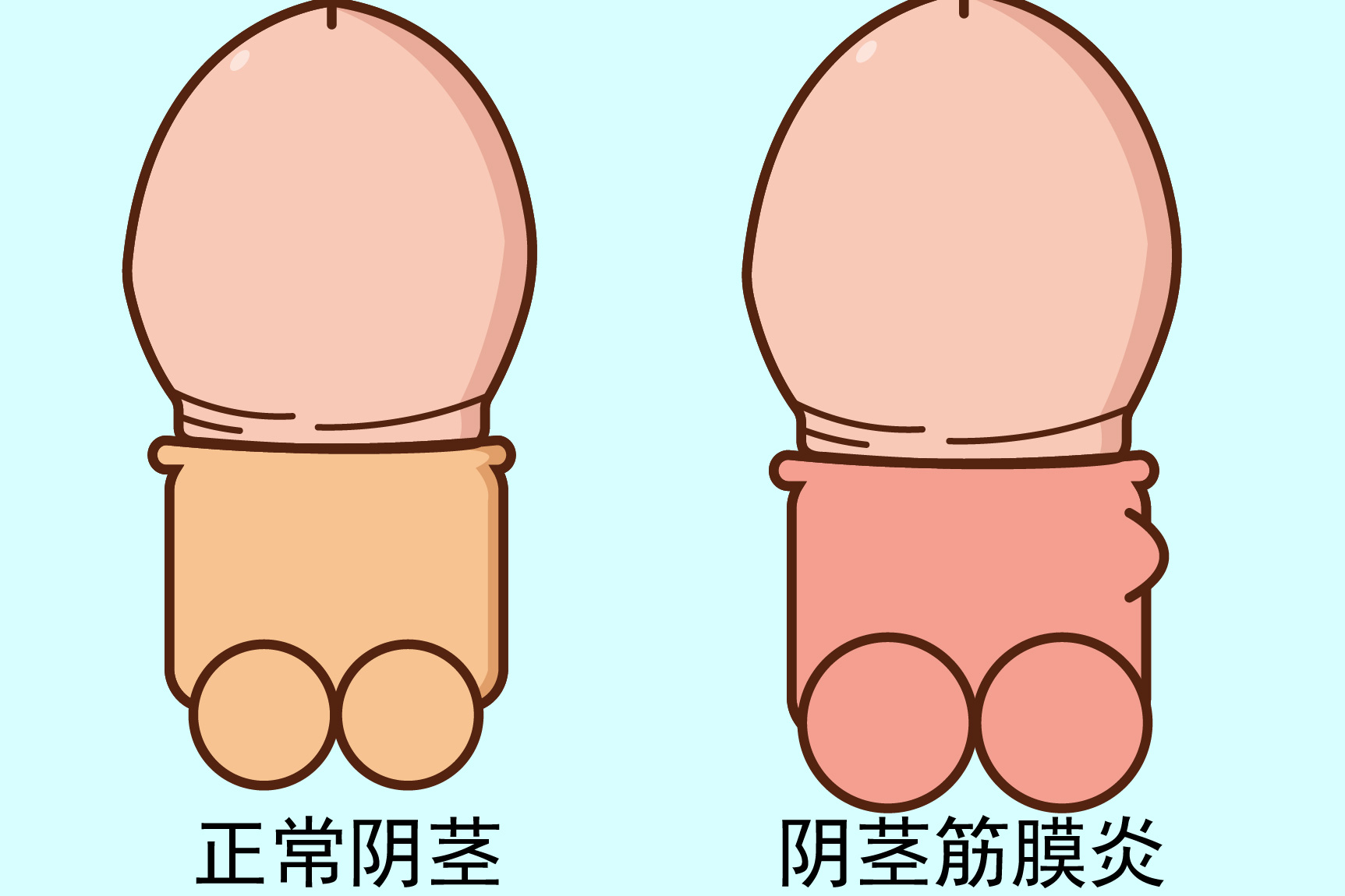 阴茎筋膜炎图