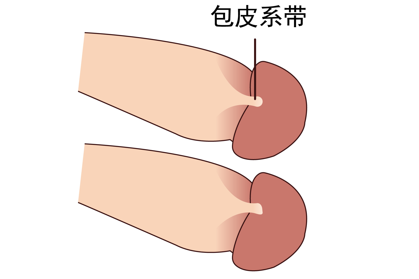 割包皮后系带歪了图