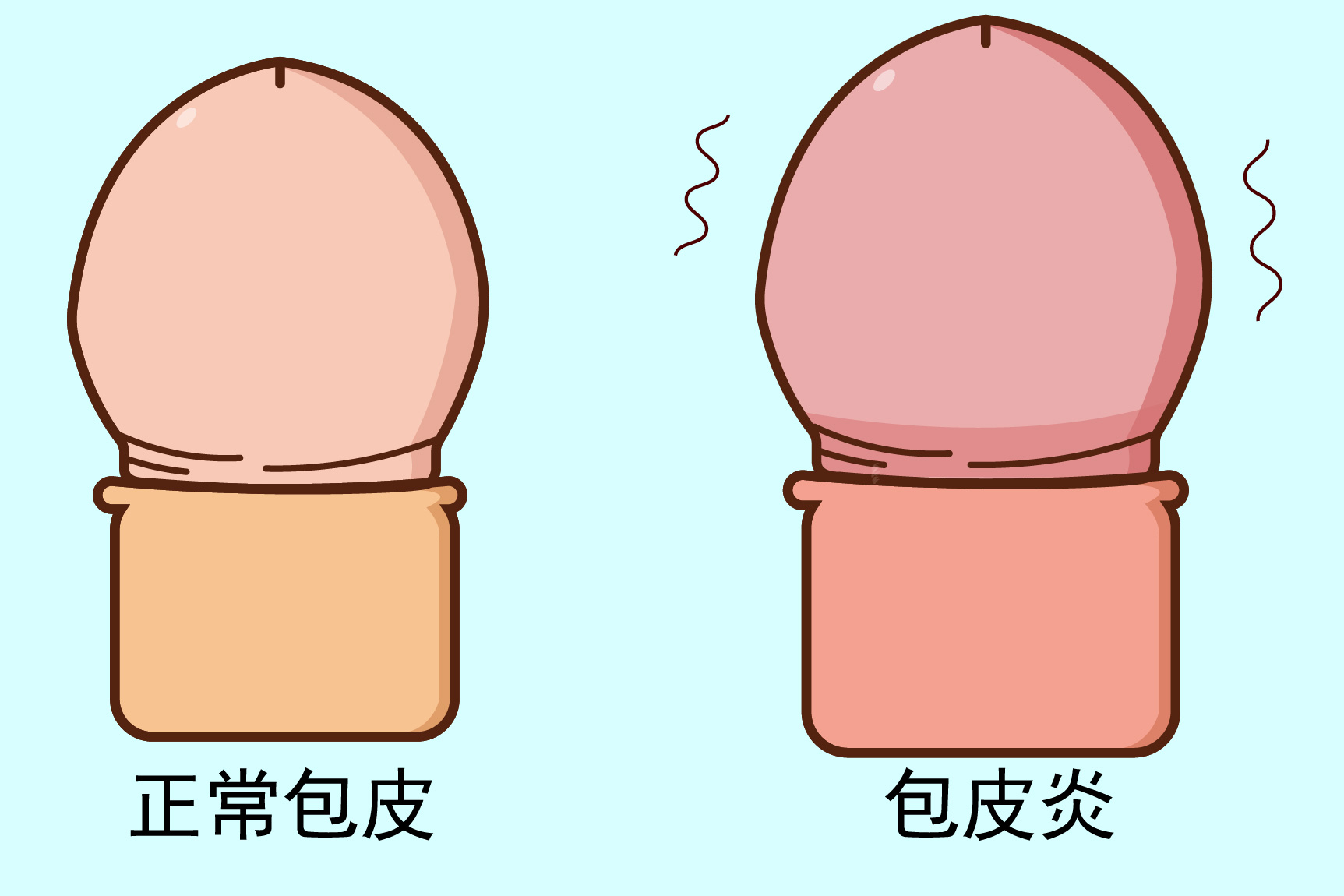 慢性包皮炎图片