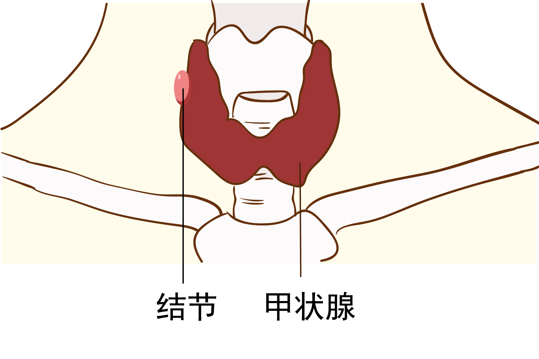 甲状腺结节图片