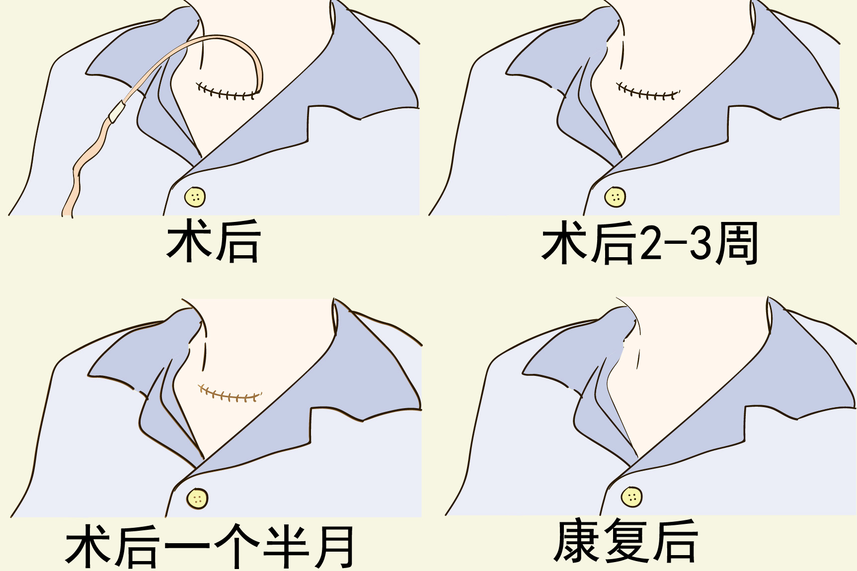 甲状腺术后伤疤图