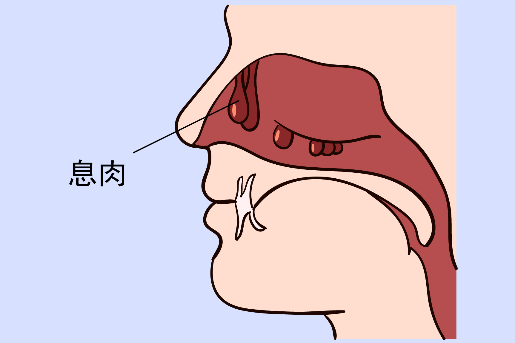 鼻炎鼻息肉图片