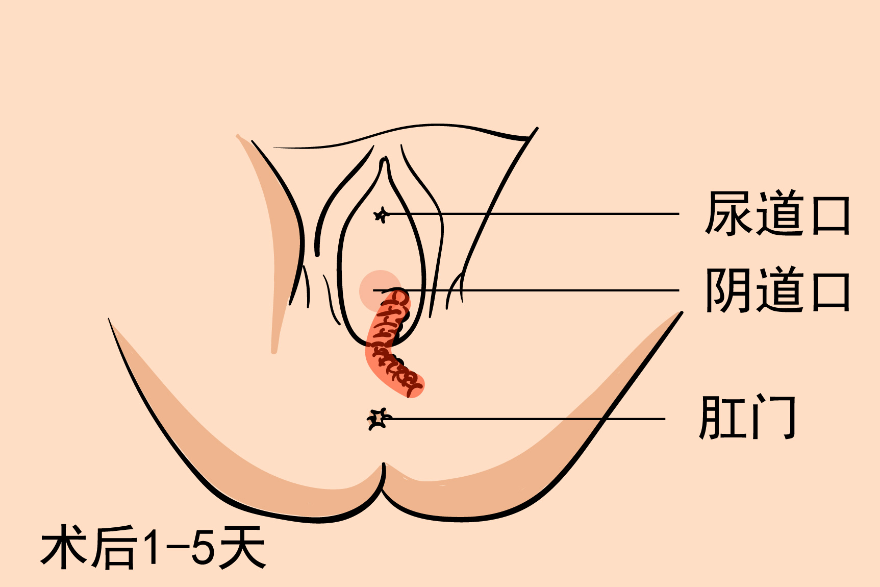 侧切恢复疤痕图