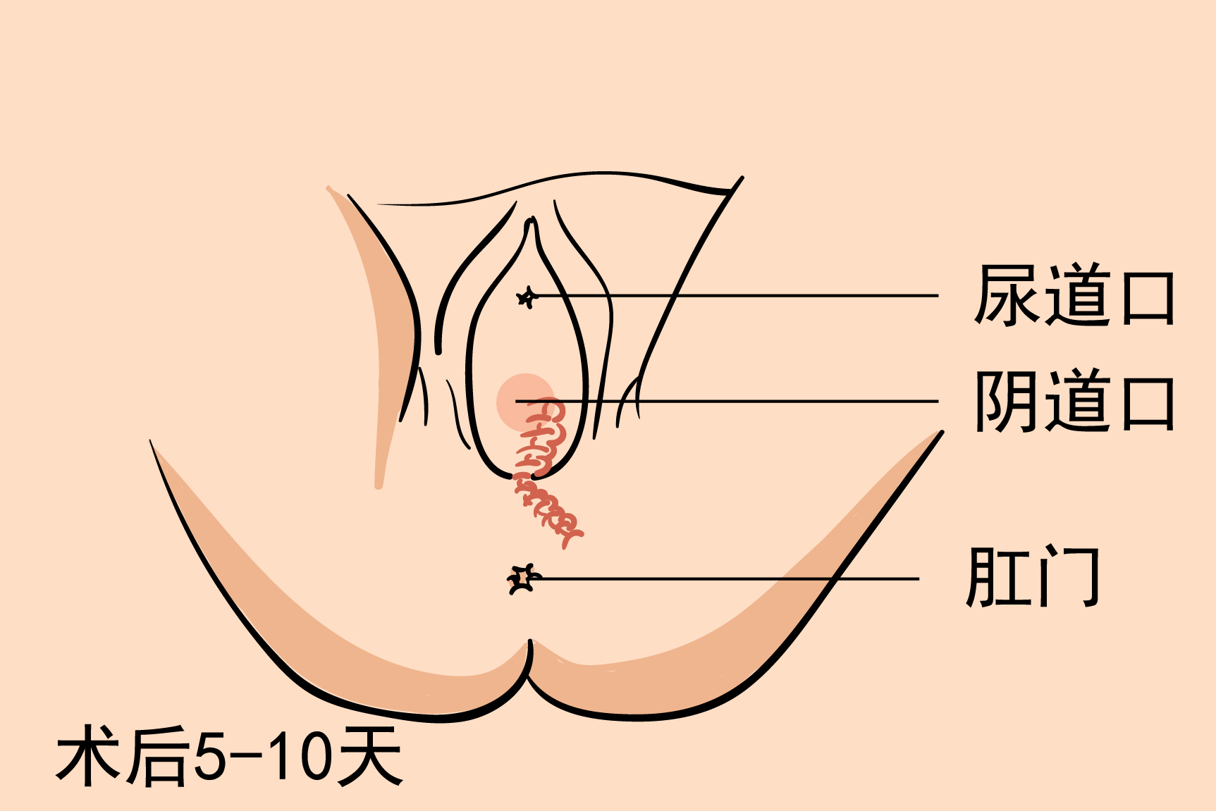 侧切恢复疤痕图