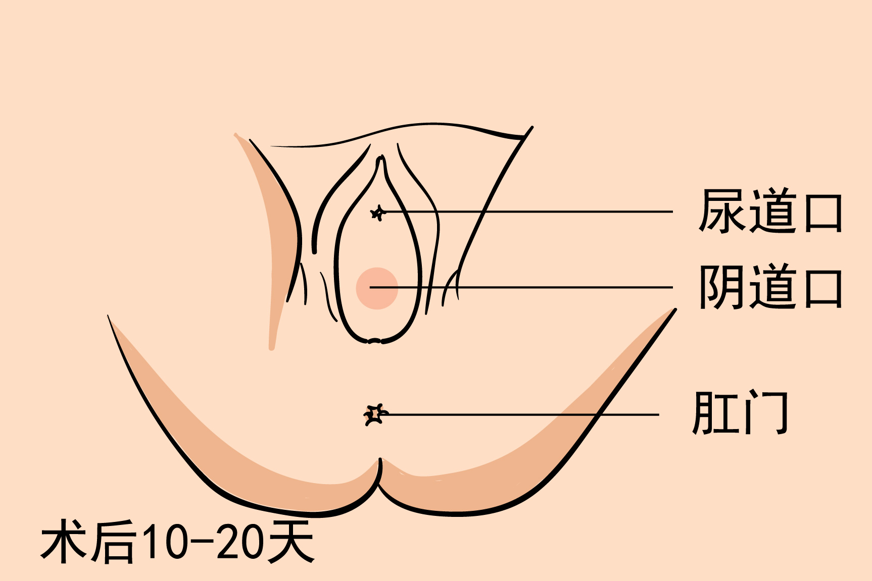 侧切恢复疤痕图