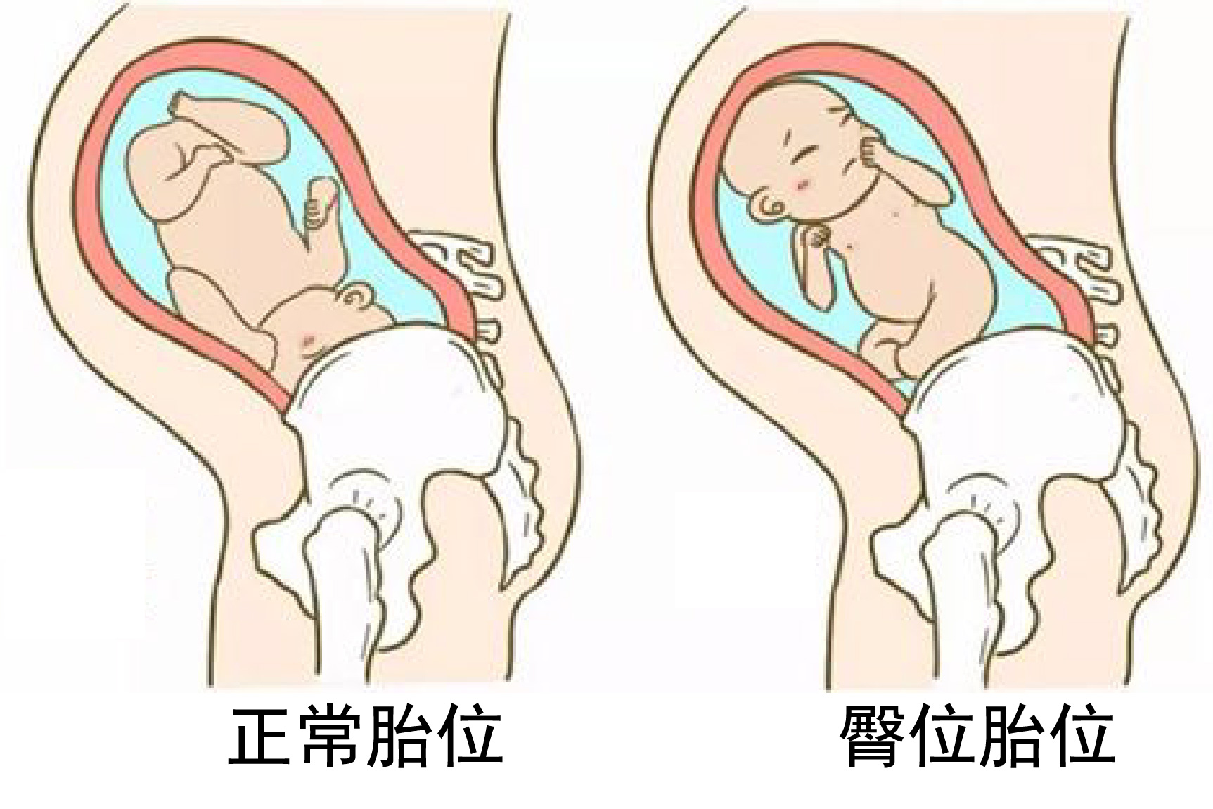 怀孕八个月臀位胎儿图