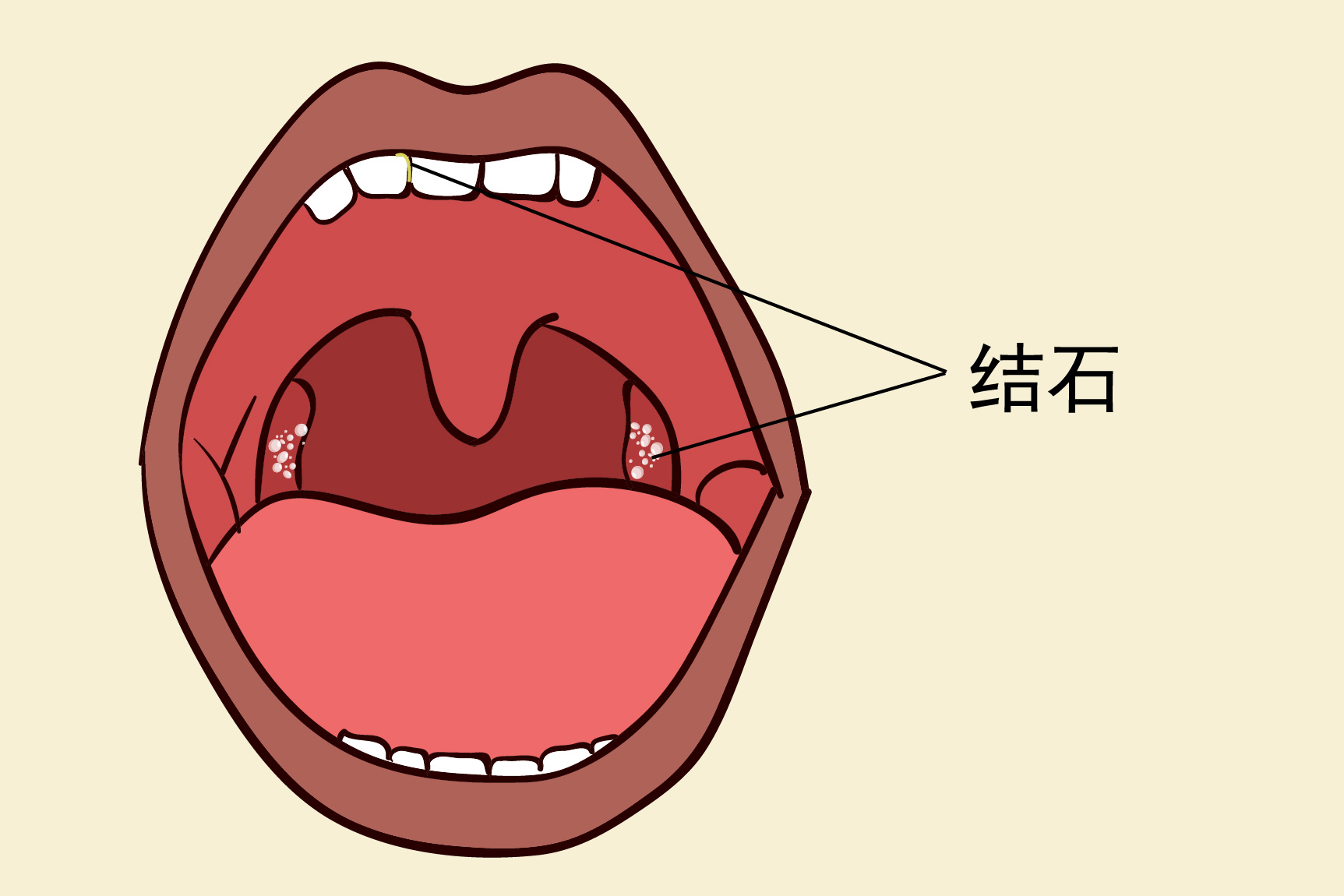 口腔吐出小黄粒图