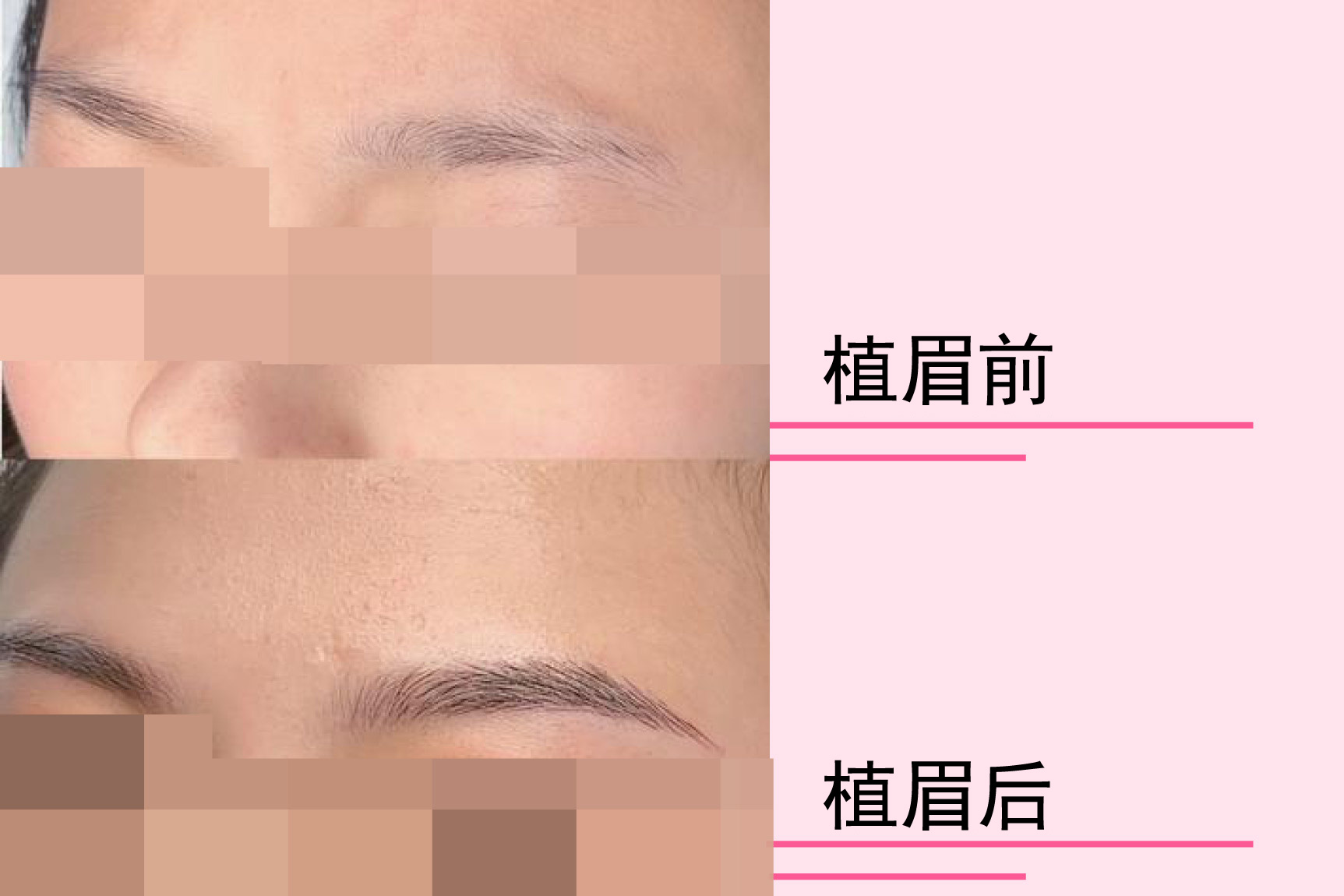 植眉毛前后对比图