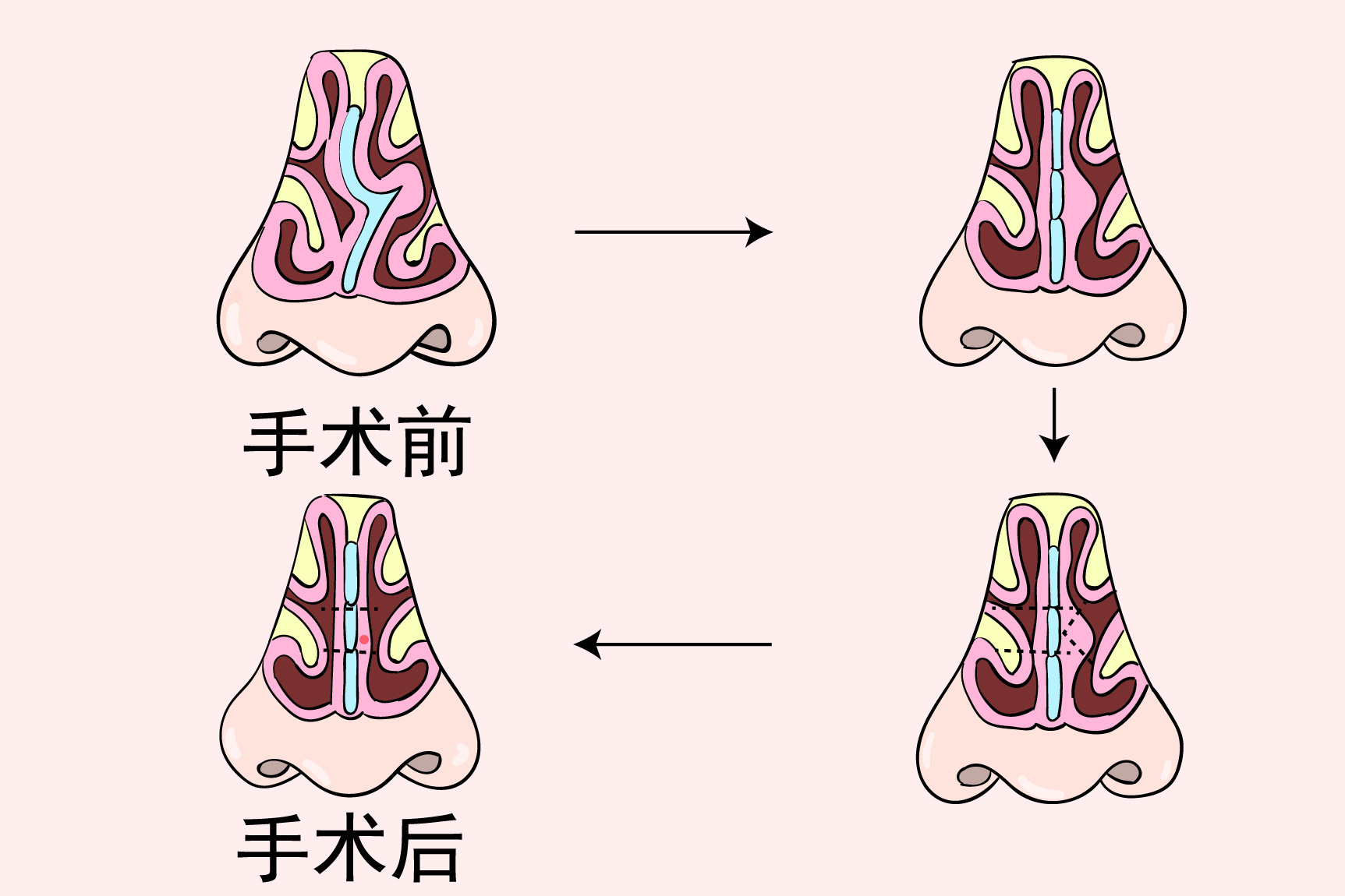 鼻中隔手术原理图