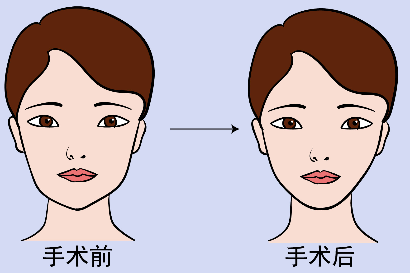 取颊脂垫效果图