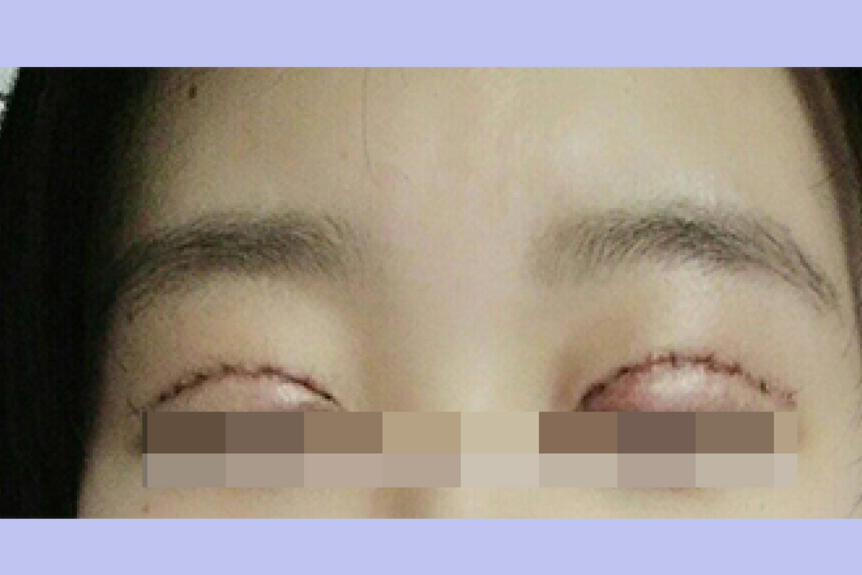 刚刚做完双眼皮没拆线的照片