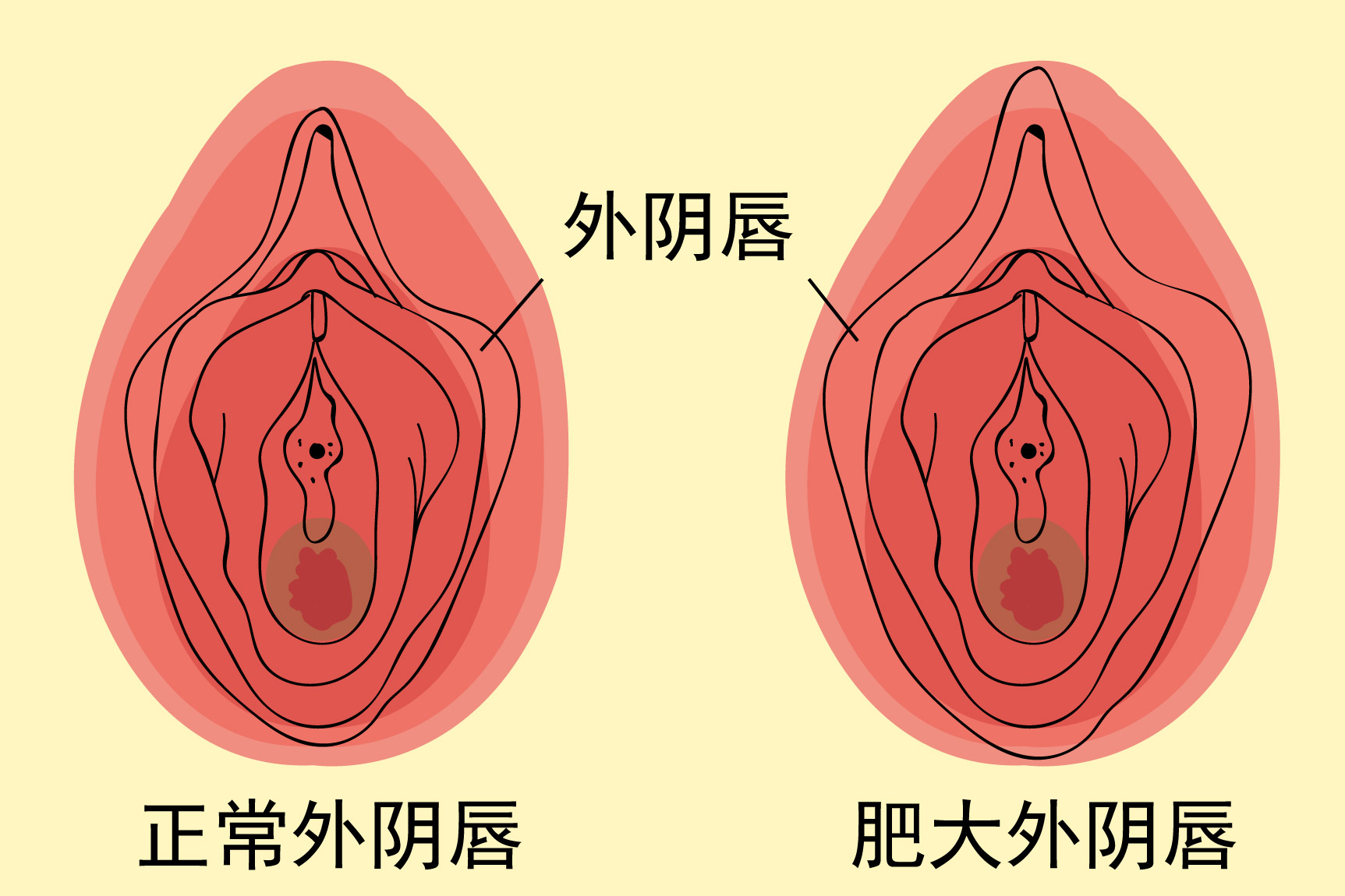 外阴唇肥大图