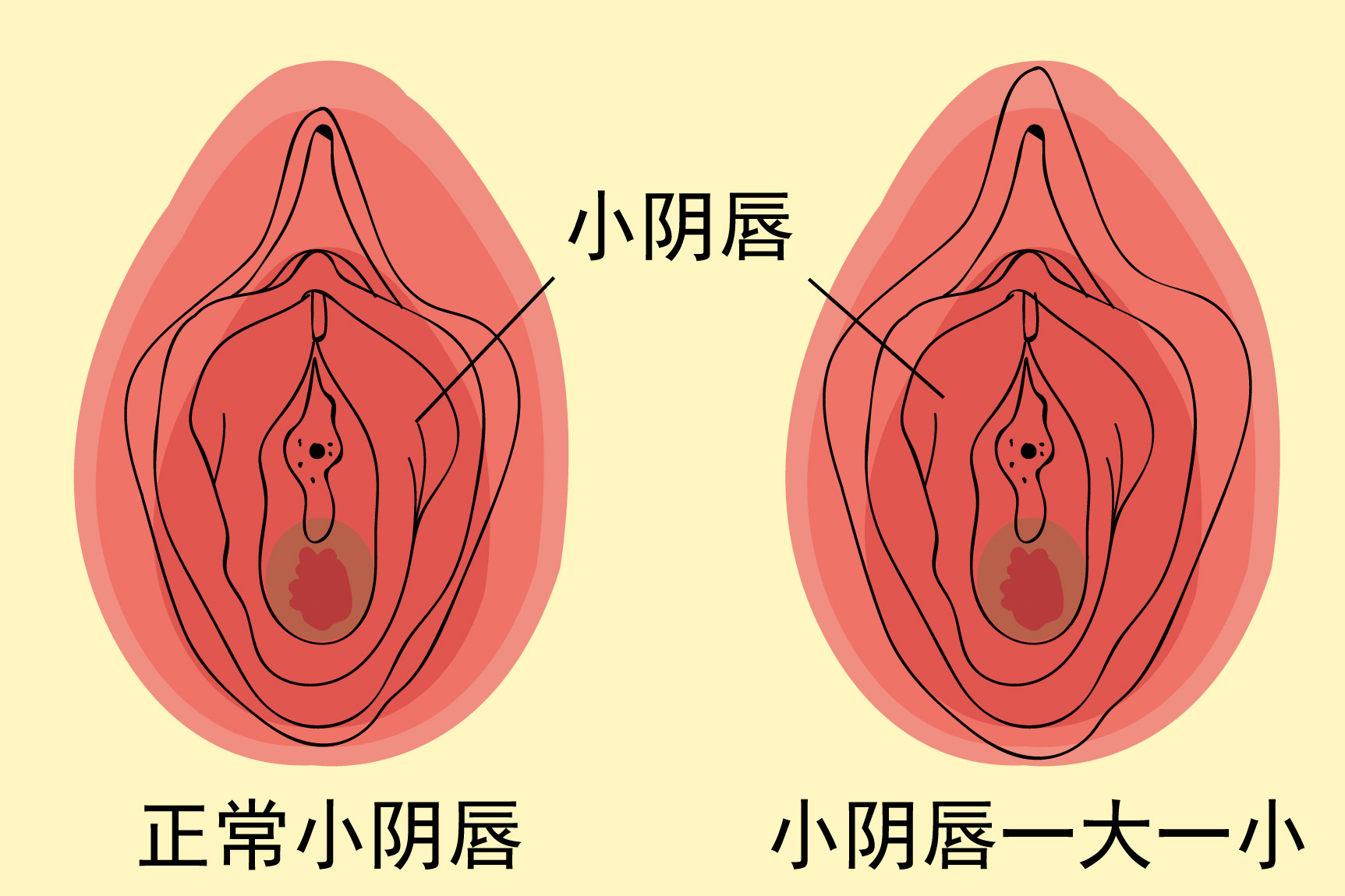 小阴唇一大一小图