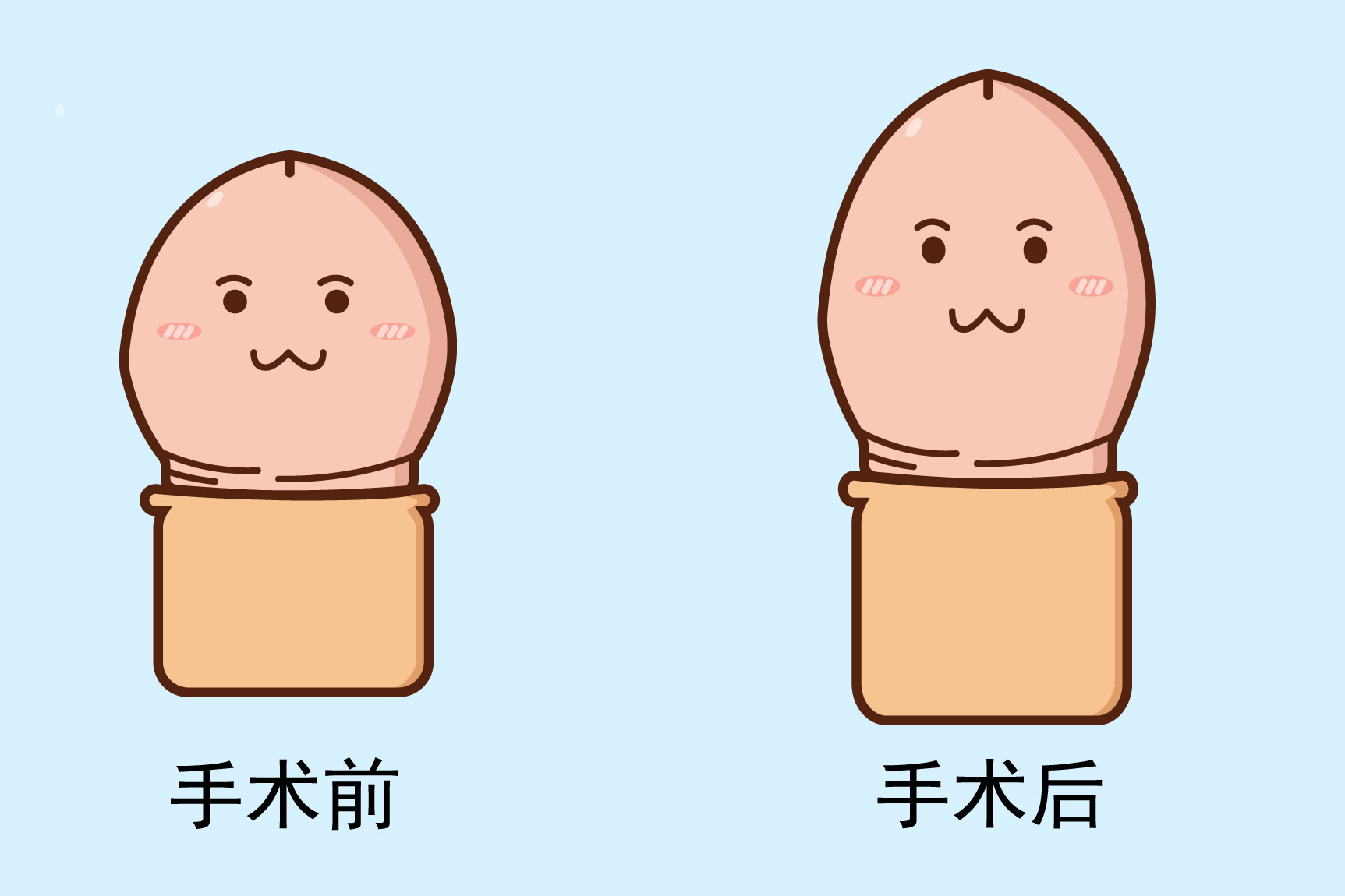 阴茎延长手术图