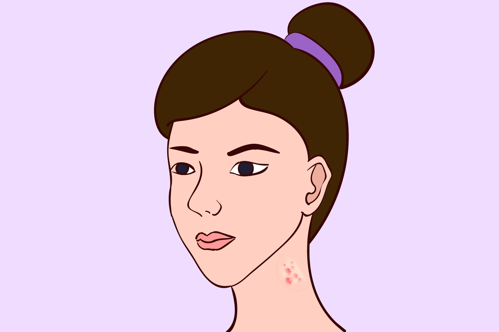女性脖子长痘图片