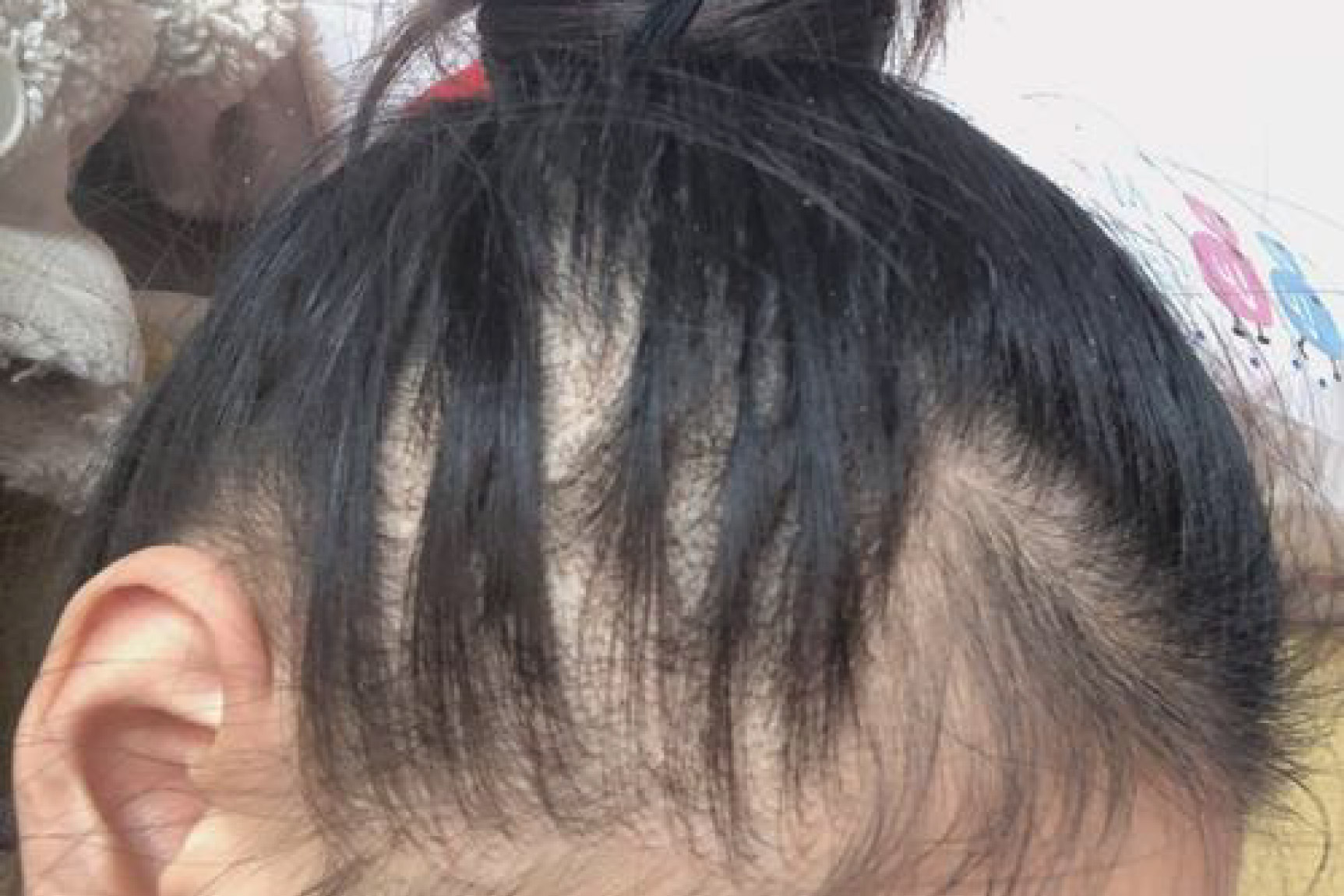 耳朵两侧脱发图