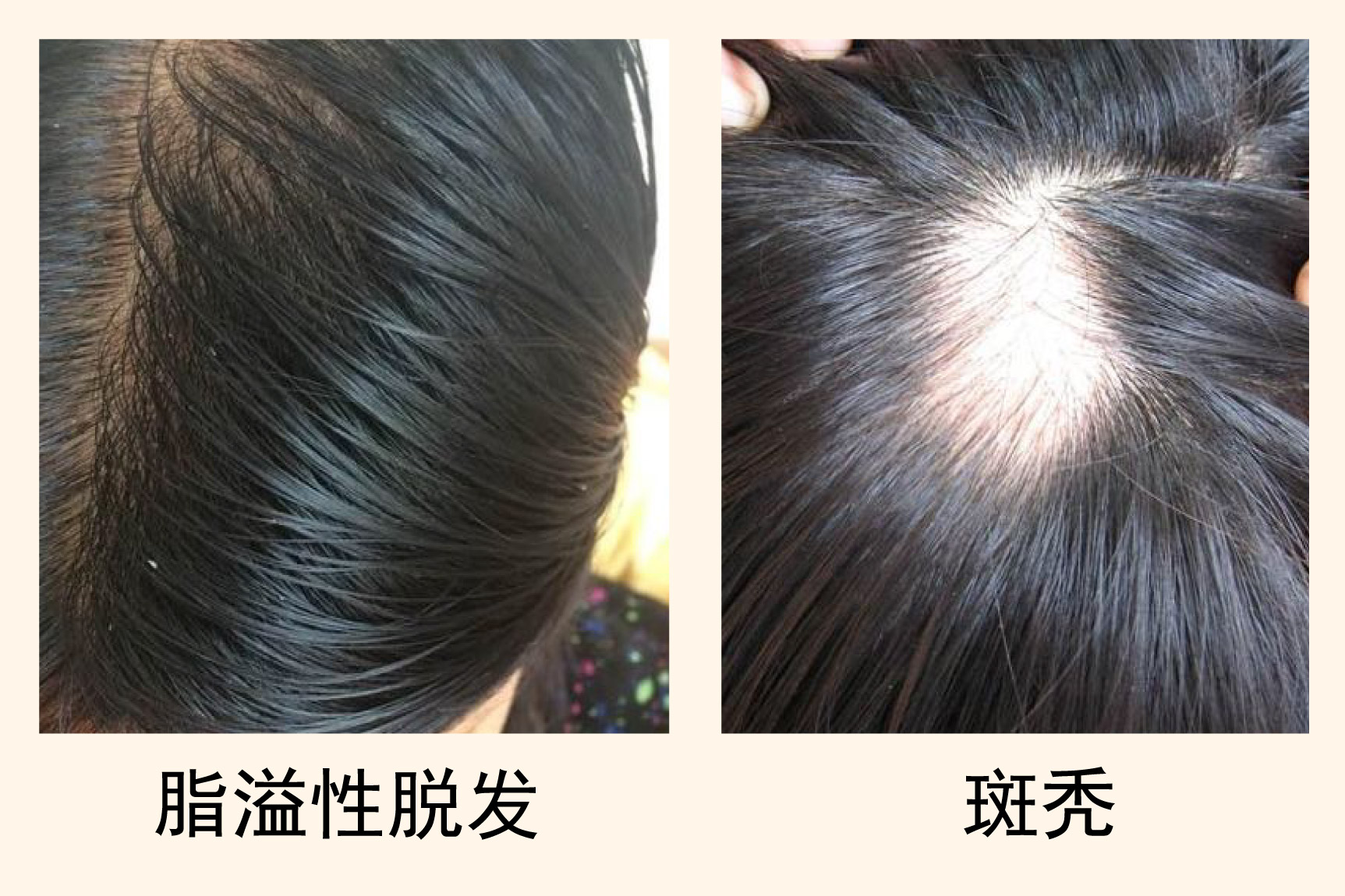 脂溢性脱发和斑秃图