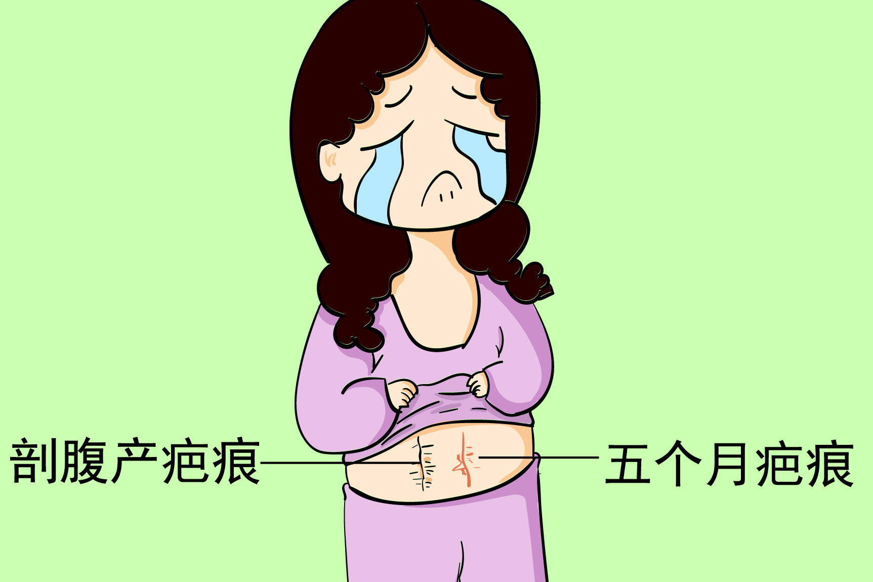 剖腹产疤痕图片