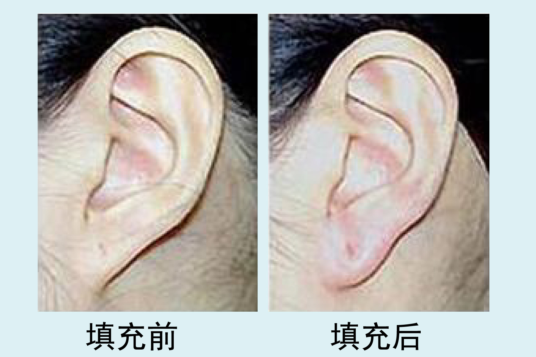 玻尿酸填充耳垂效果图