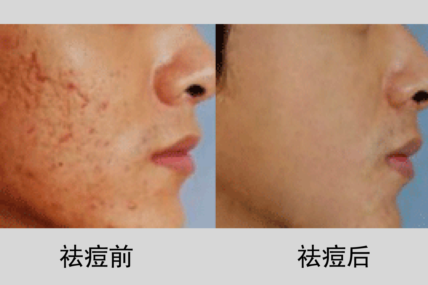 红痘印怎么去除图片