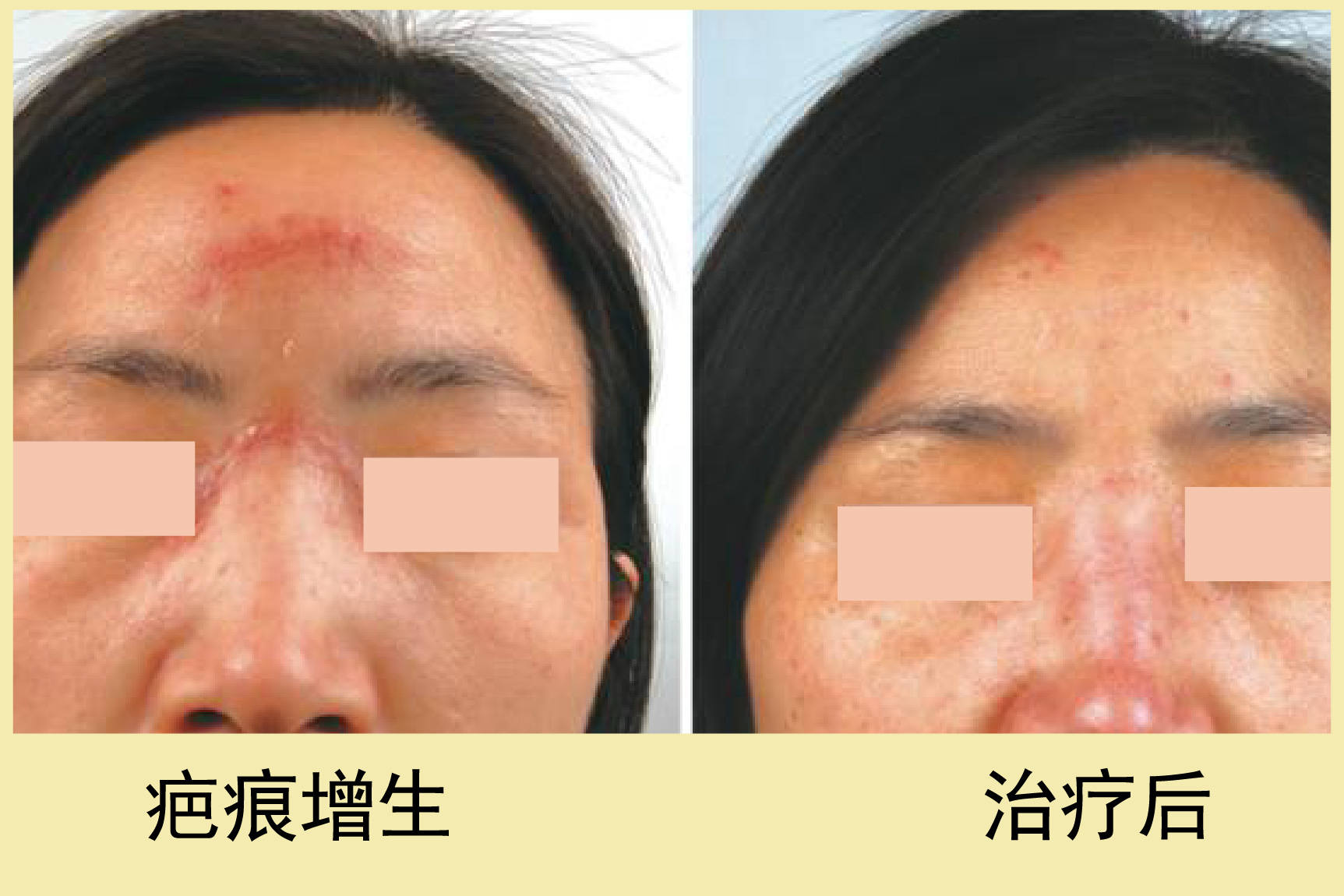 拉皮术后疤痕增生图