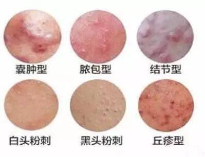 结节脓疱型痘痘图片