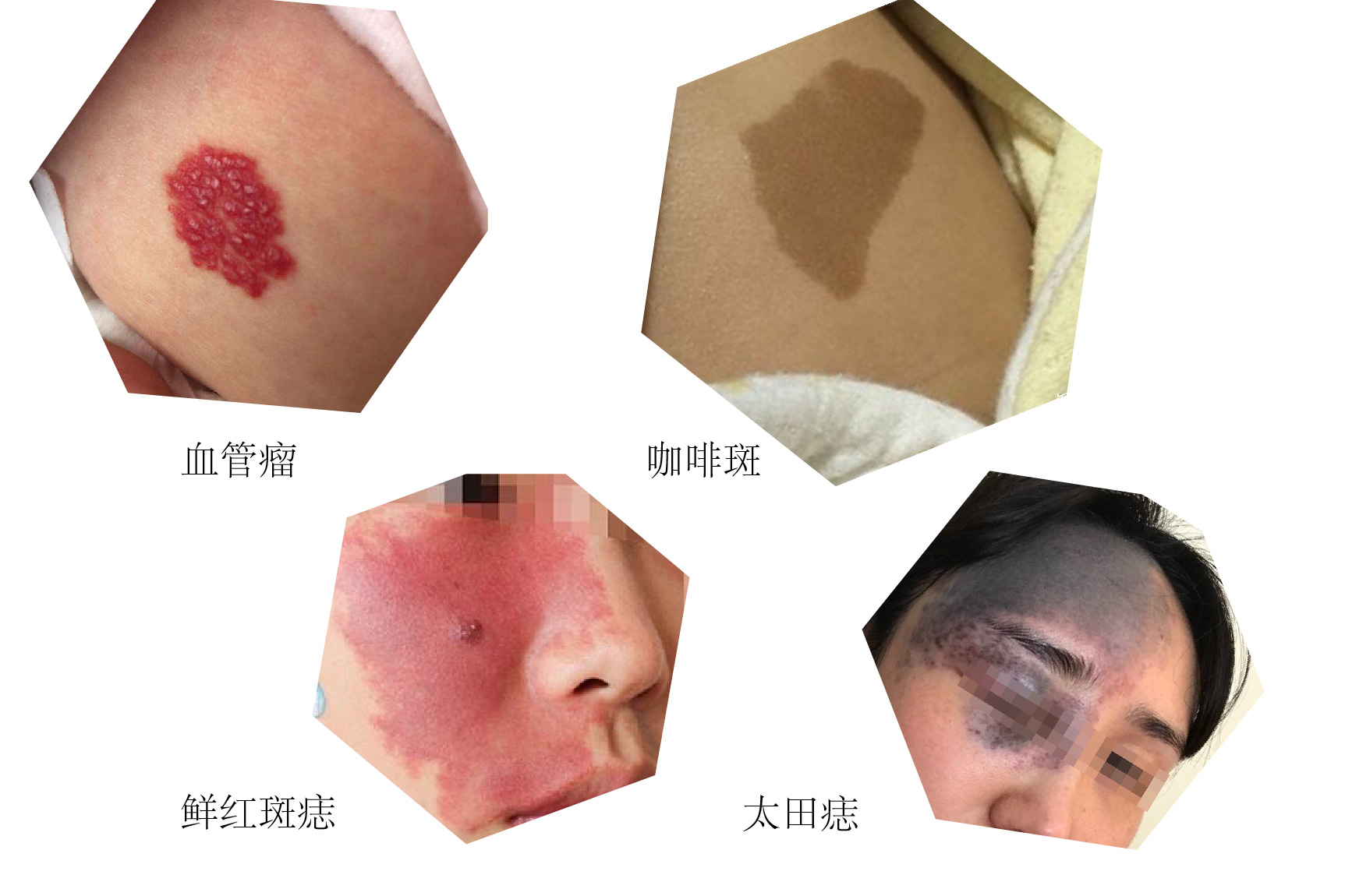 胎记斑图片
