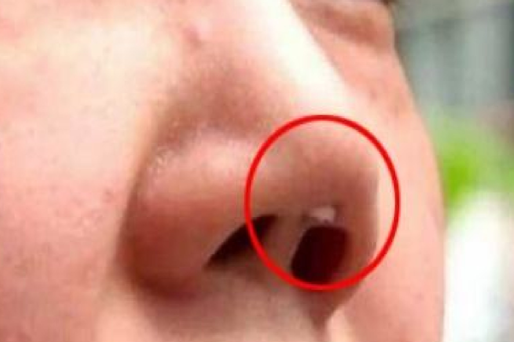 鼻假体顶穿鼻尖照片