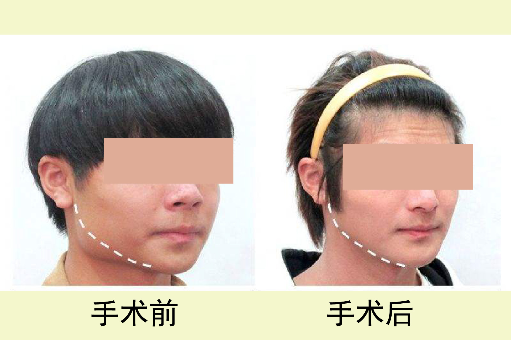 男生磨骨前后对比照片