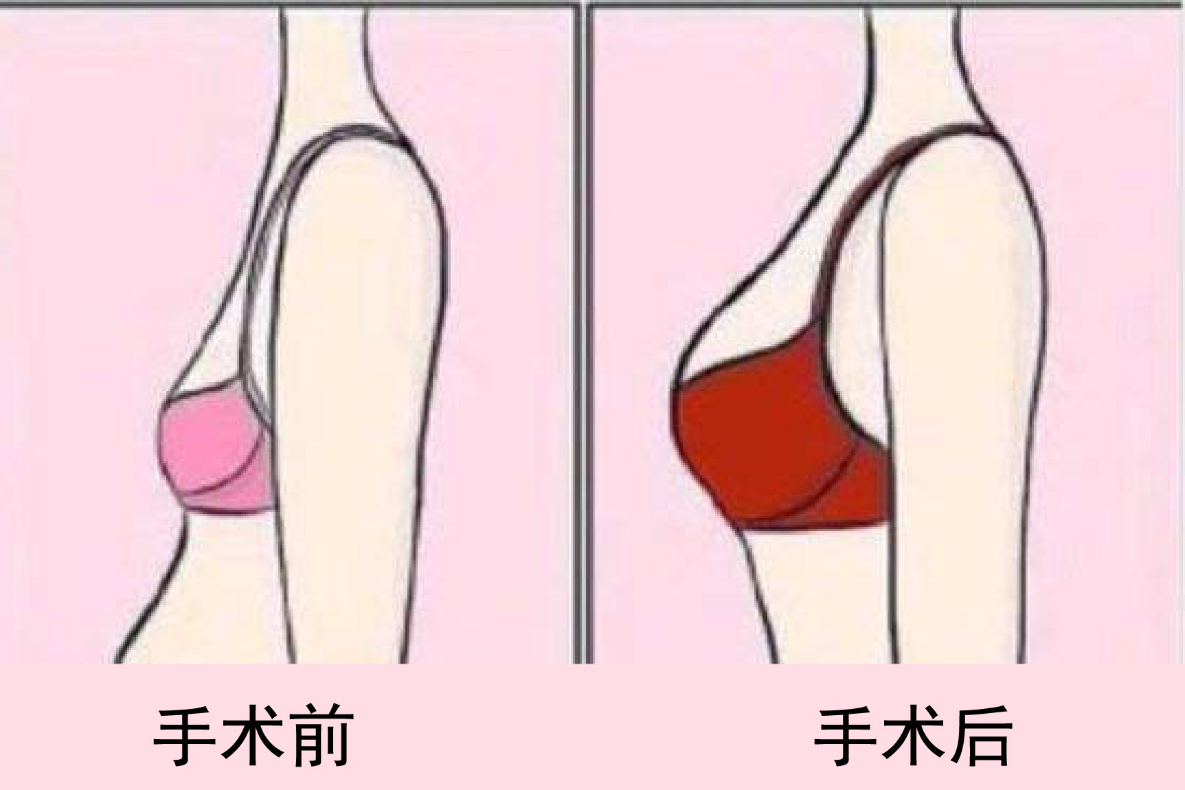 女生隆胸前后正侧面对比图
