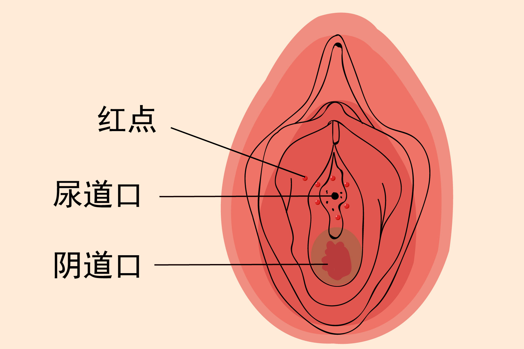 尿道口有红点图片