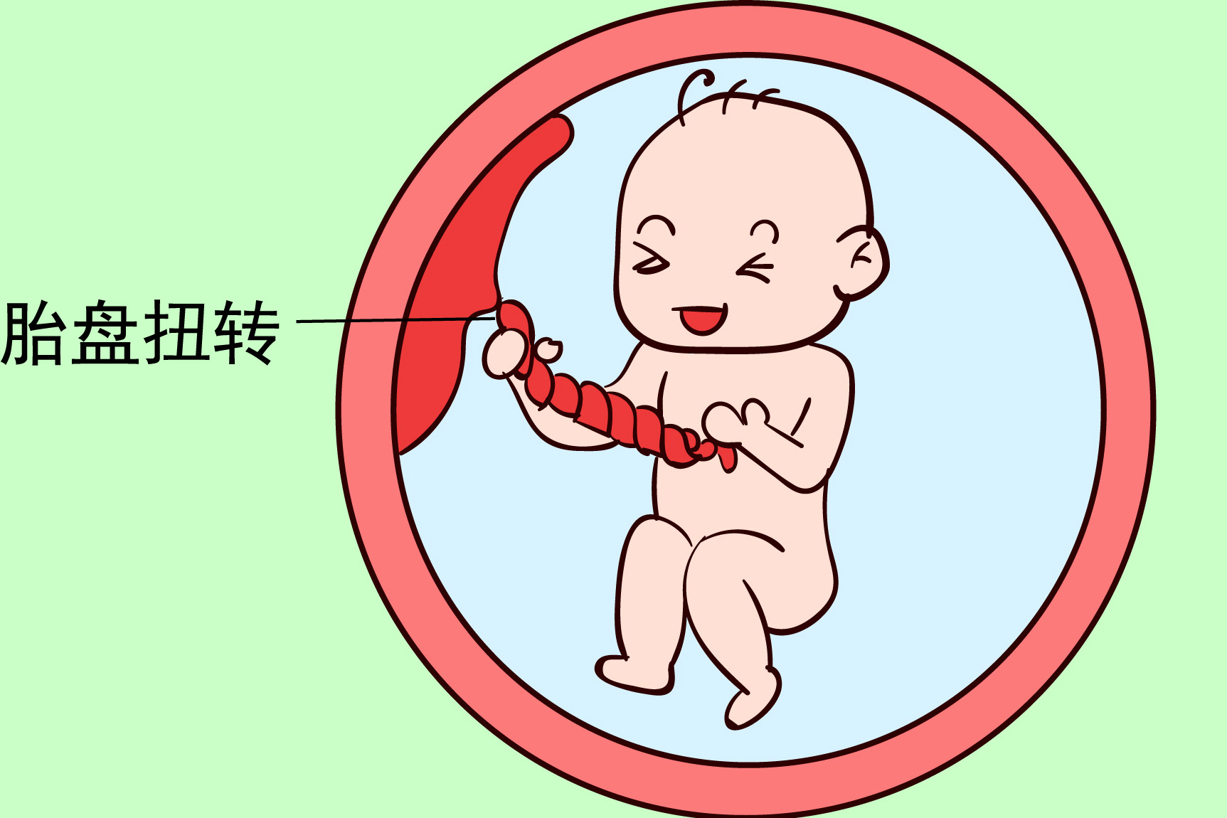 胎盘扭转图片