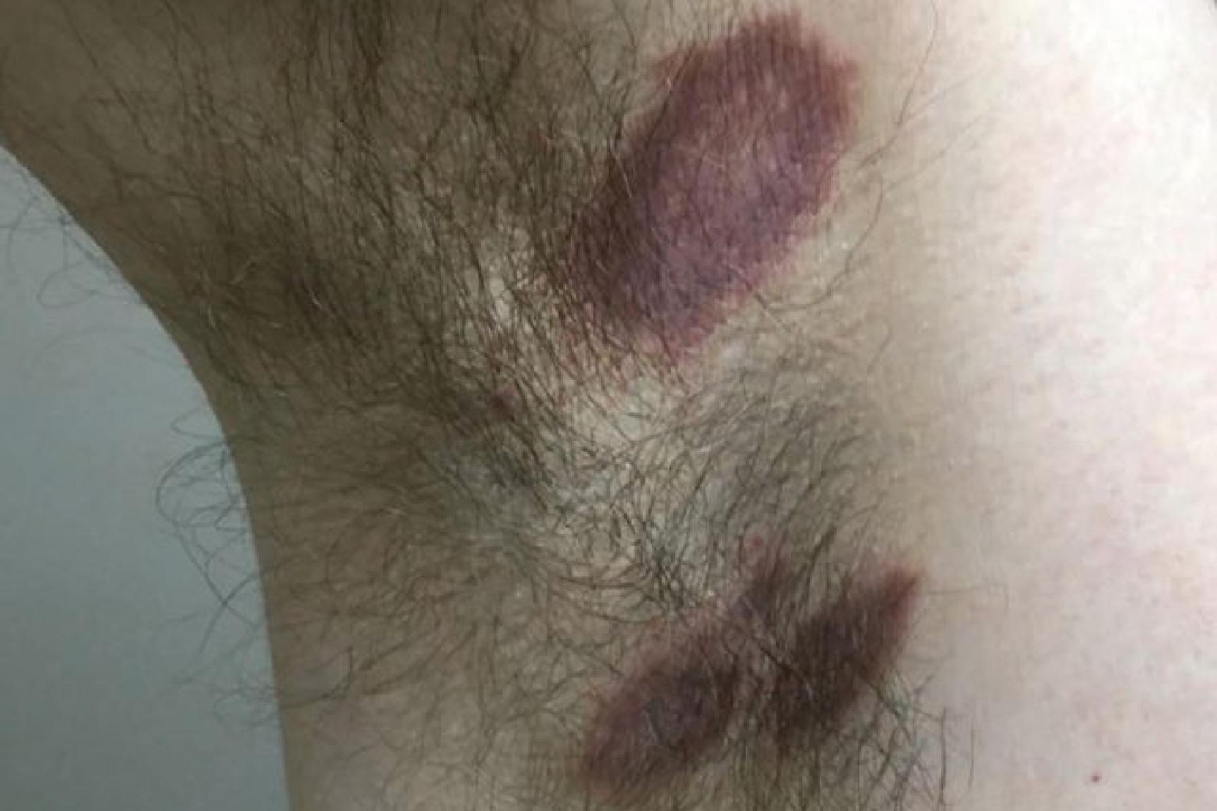 腋窝有褐色斑图片