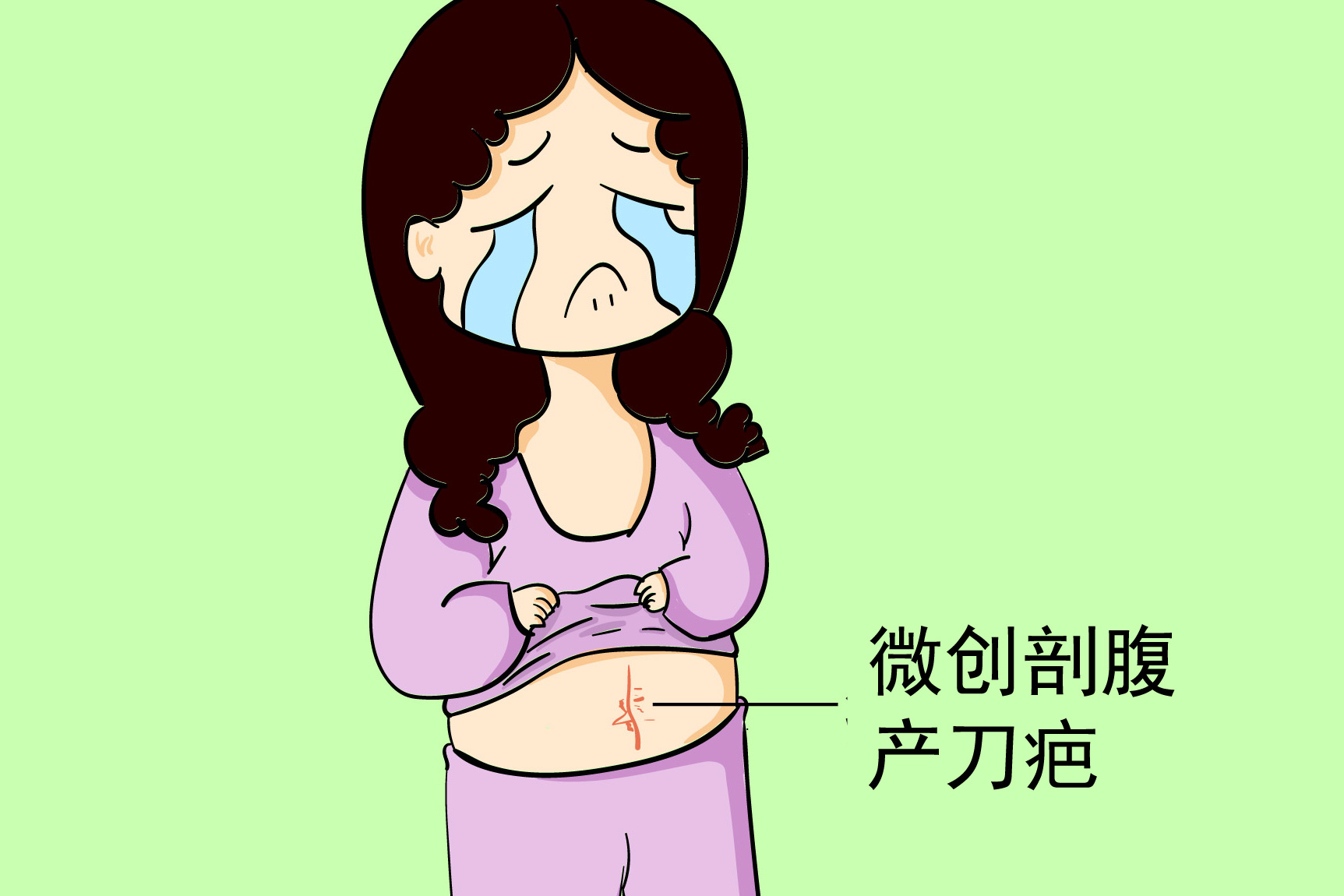 微创剖腹产刀疤图片