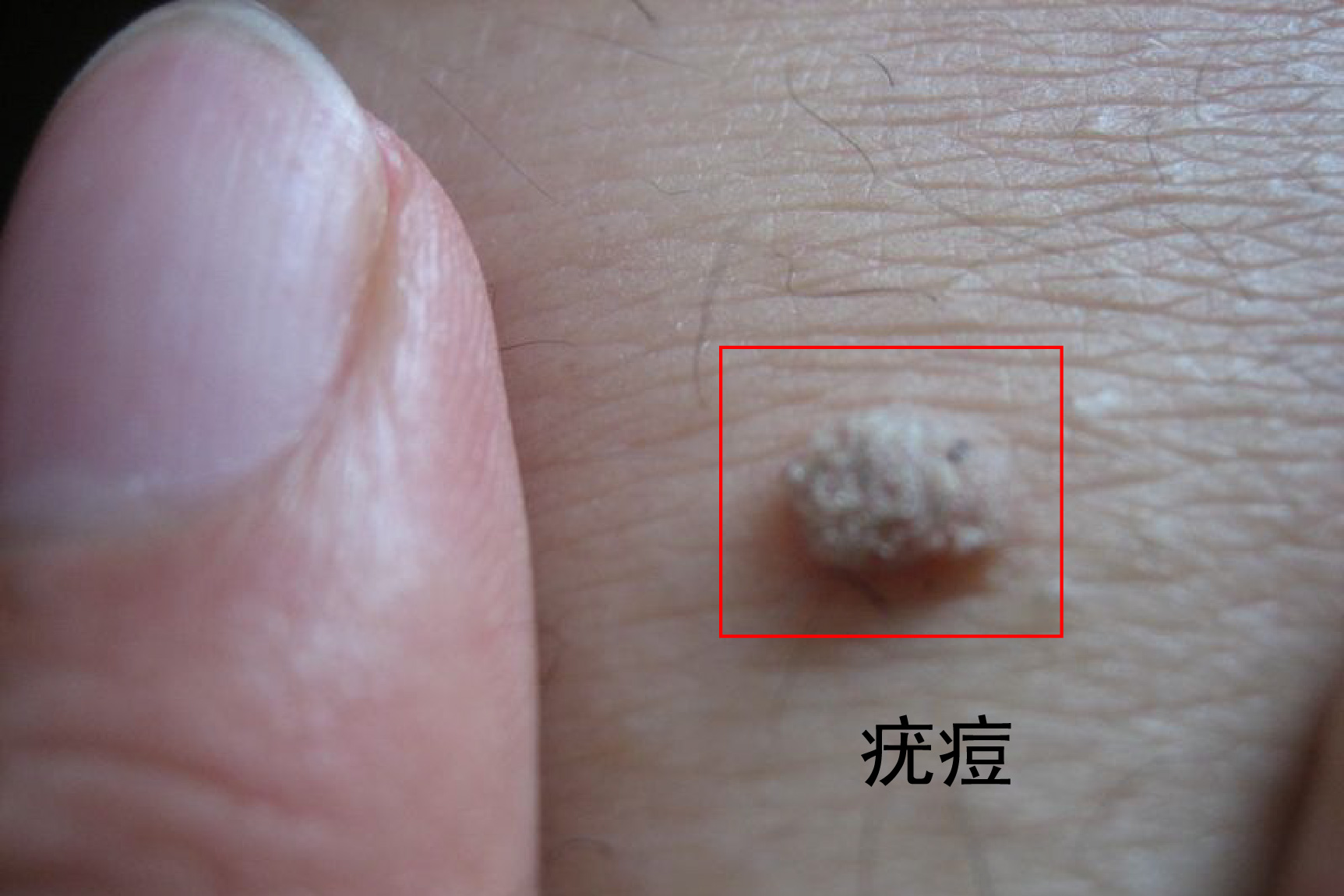 疣痘图片