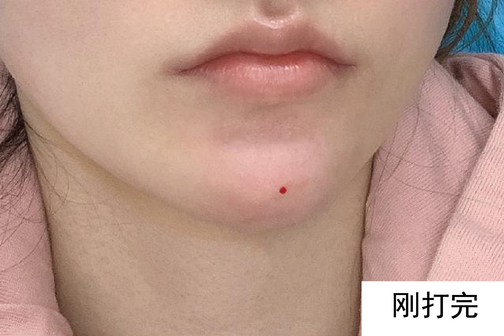 下巴打玻尿酸肿胀什么样是正常的图片