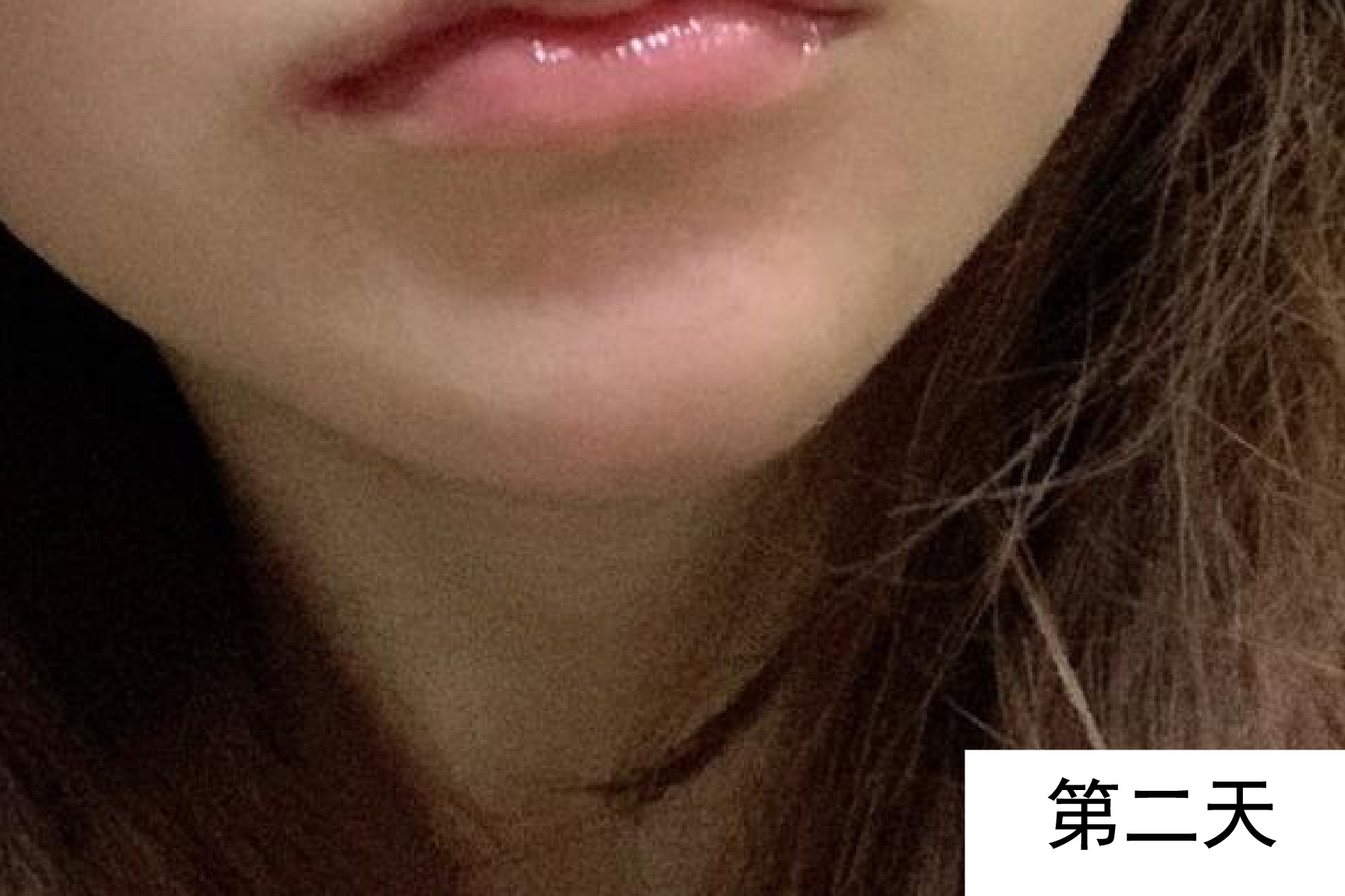 下巴打玻尿酸图片