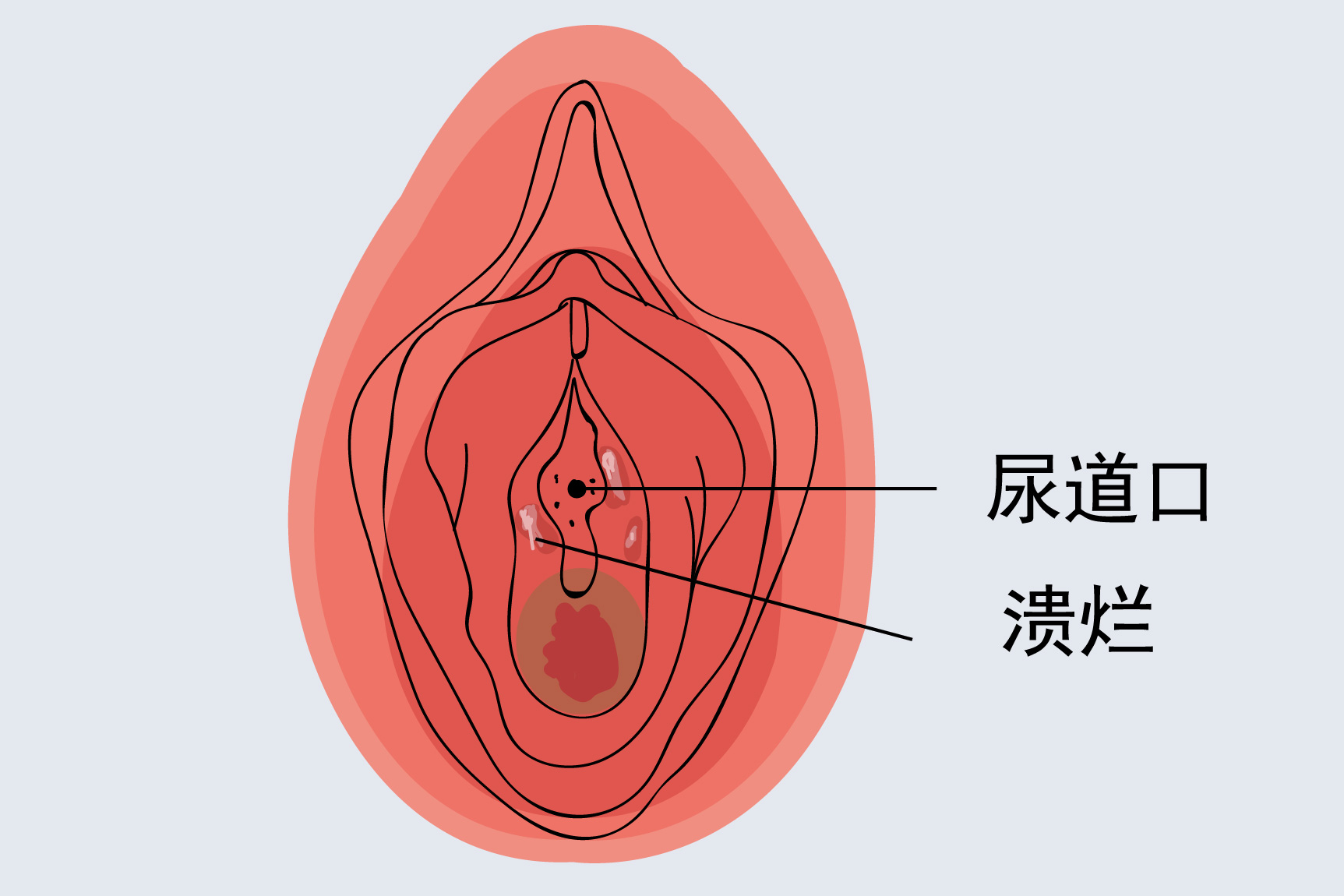 尿道口溃烂图片