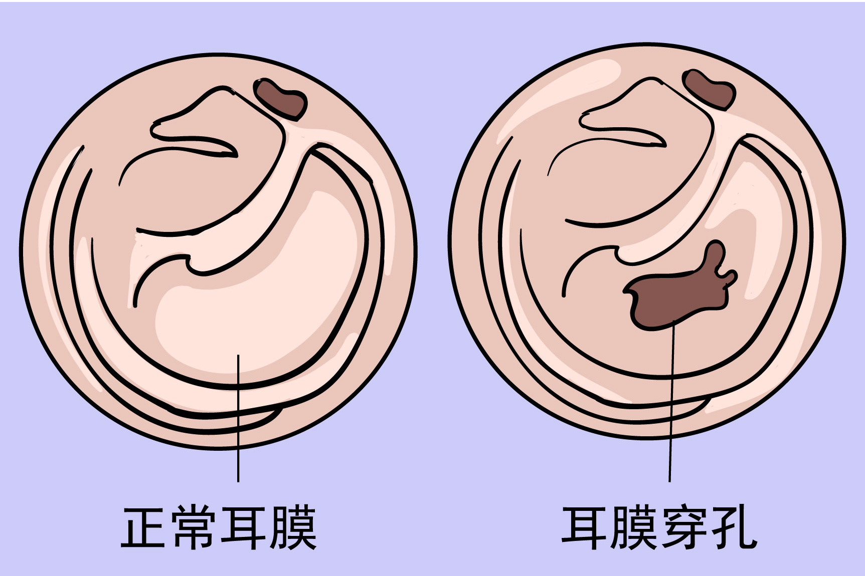 轻微的耳膜穿孔图片
