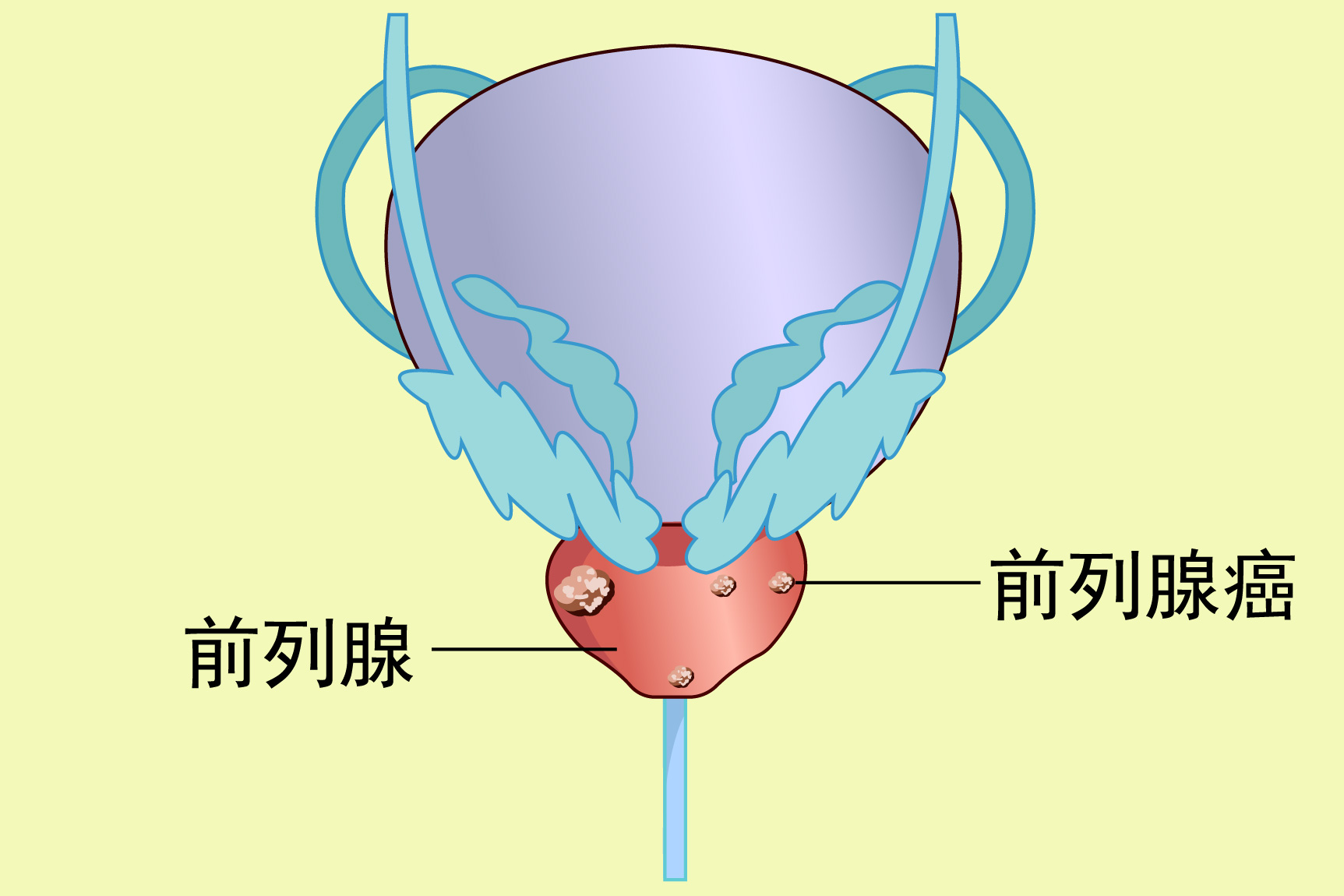 前列腺癌图片