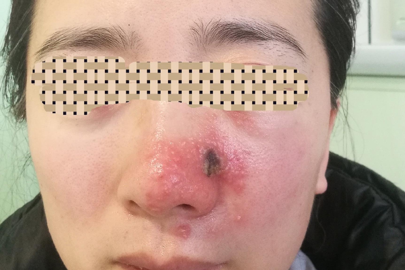 鼻综合轻度感染图片