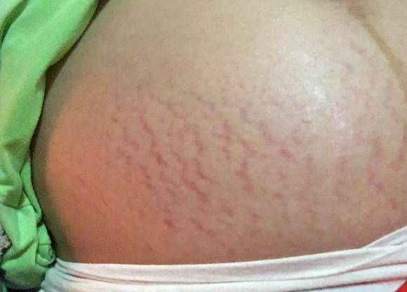 腰两侧长妊娠纹图片