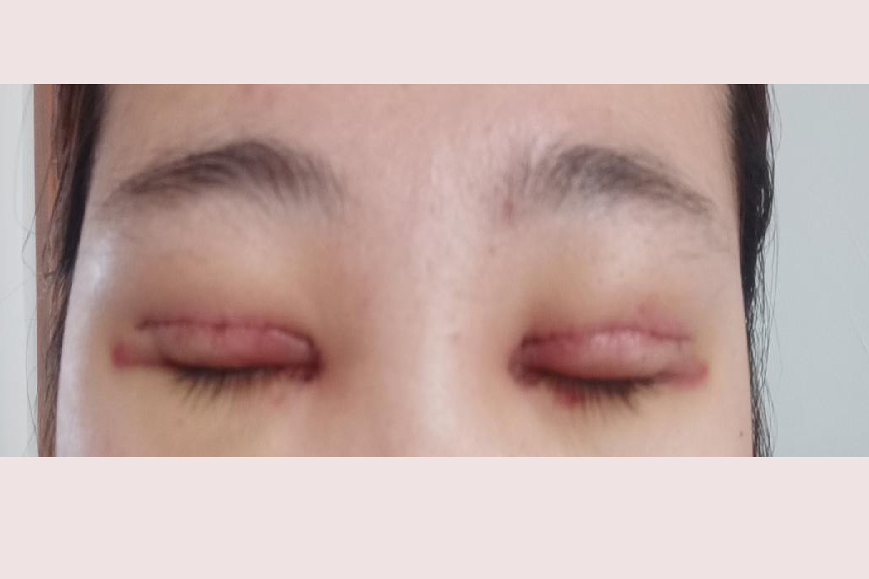 开眼角一个月了疤痕图片
