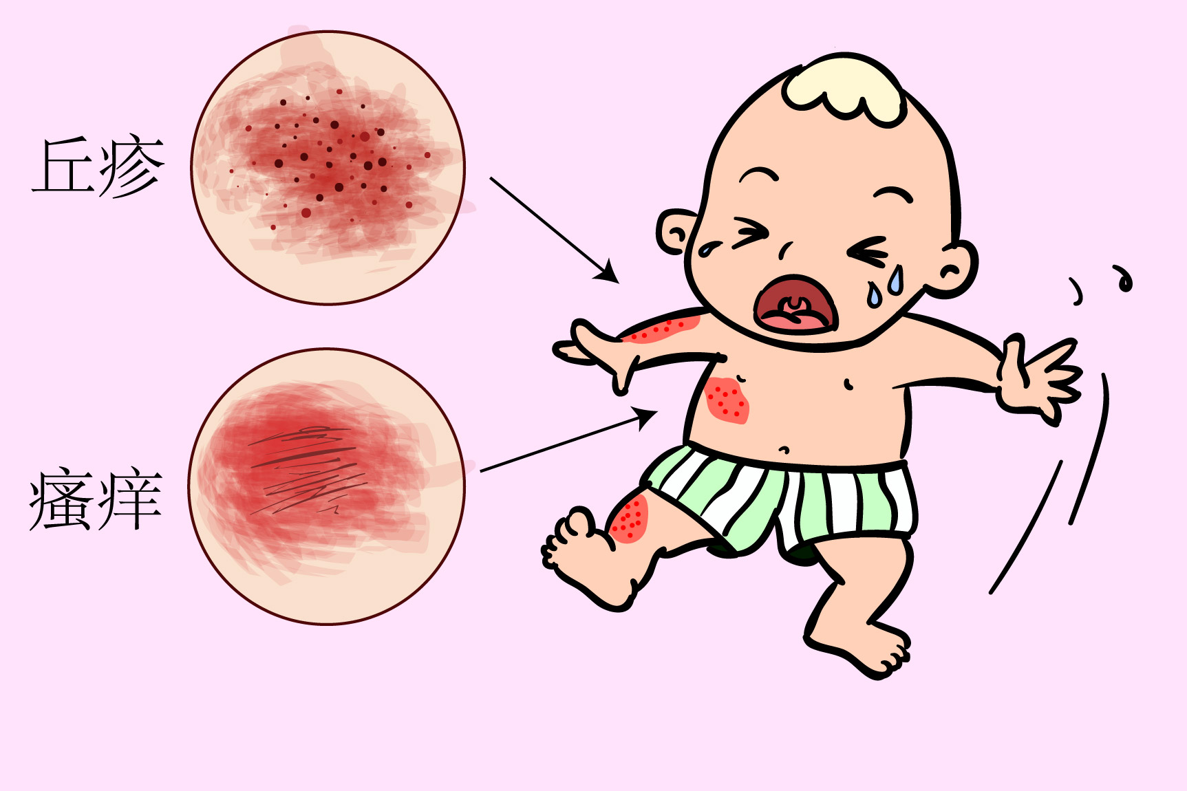 儿童过敏症状图片