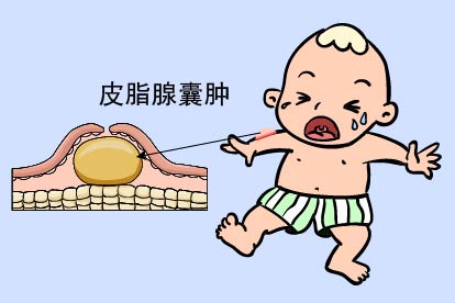 宝宝粉瘤图片
