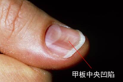 反甲图片