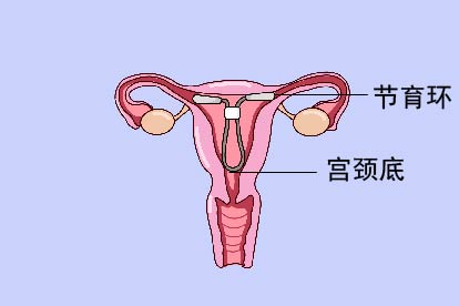 节育环位置图